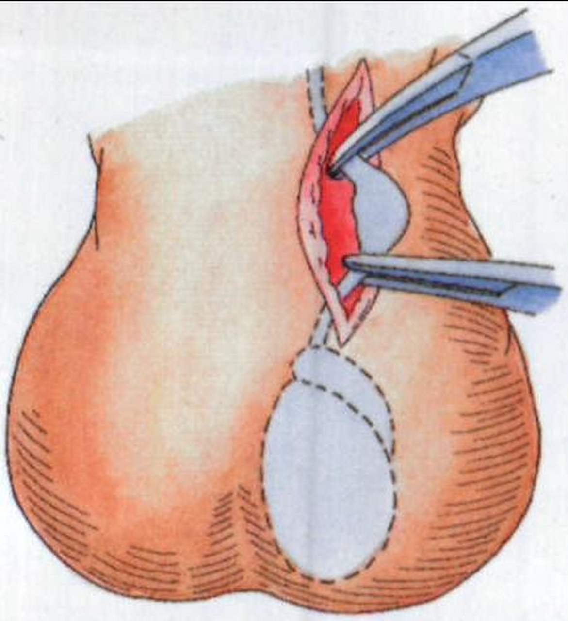 男性结扎# 男人结扎后还能解扎吗?