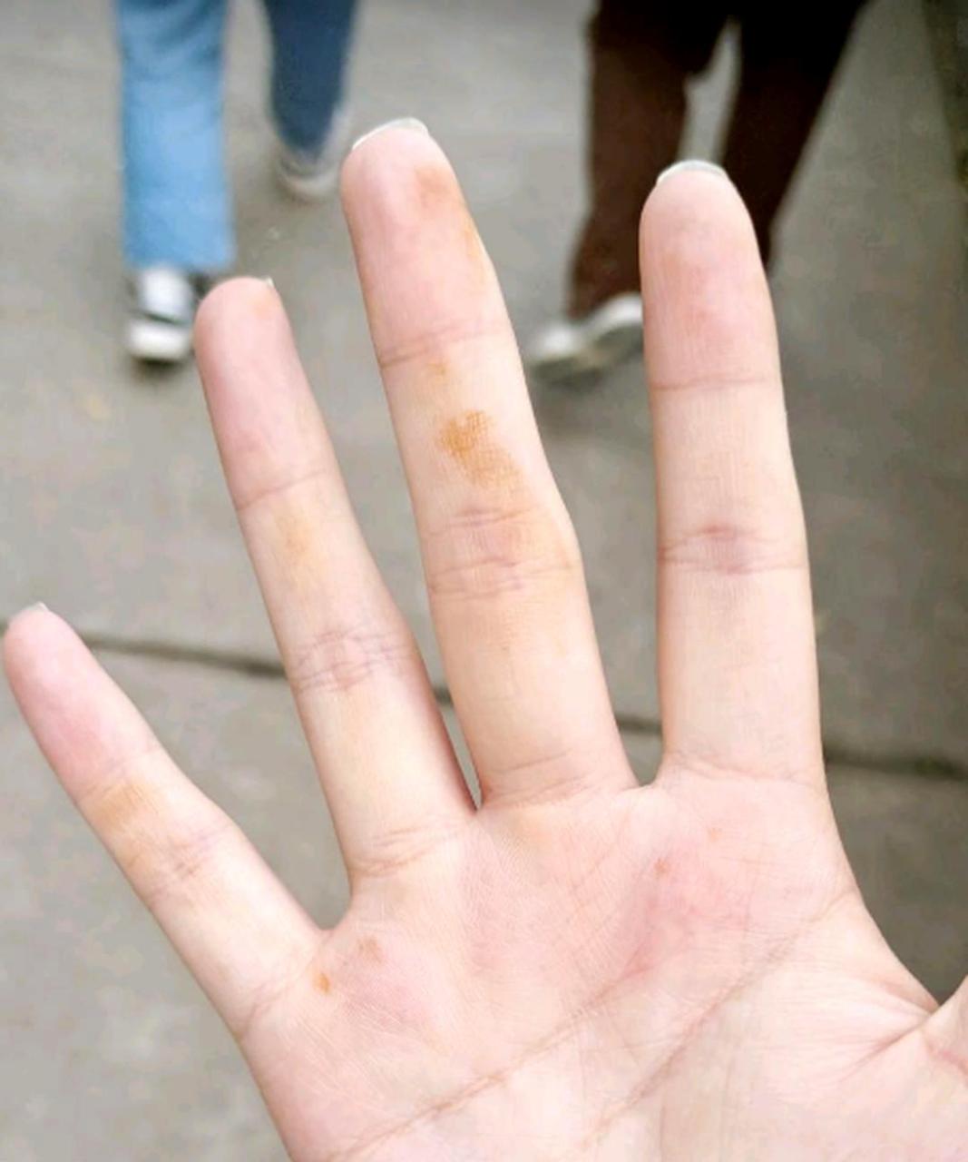 为什么睡醒后会发现手变黄,明明没有接触任何物品?