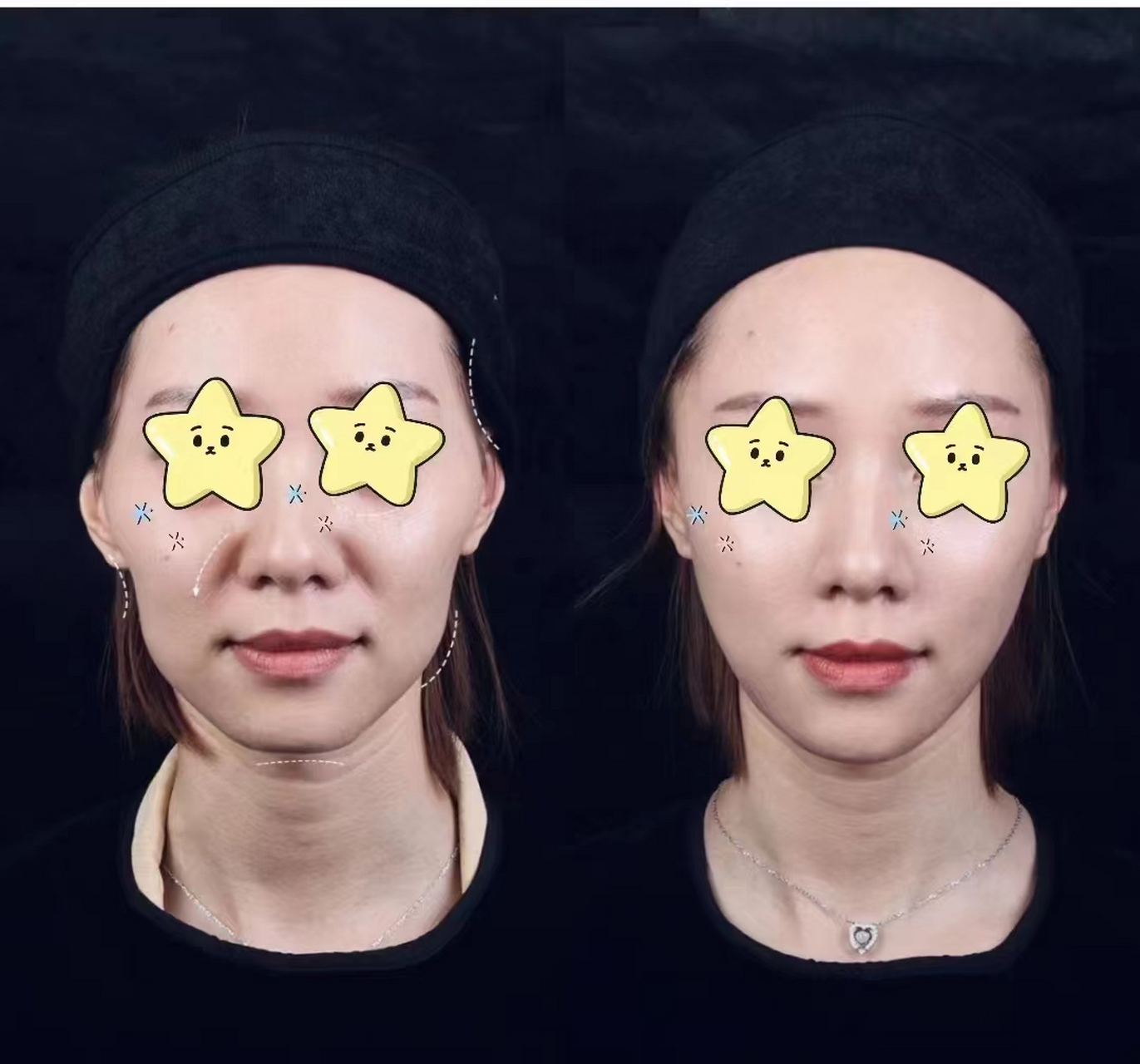 外轮廓77内轮廓固定=脸型流畅77面中饱满 这就是减龄的秘诀#烟台