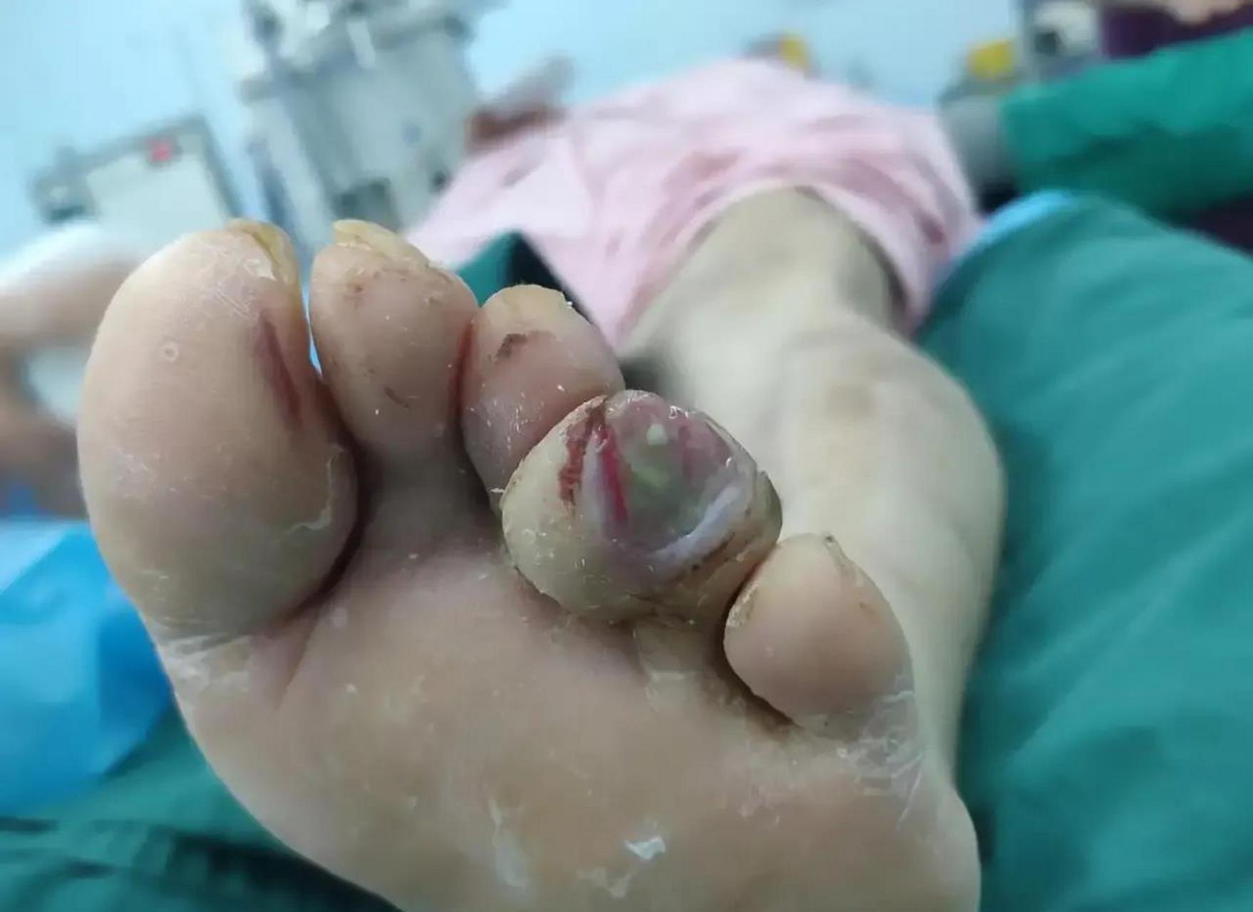 今天又做了一个糖尿病足患者的手术,右足第4足趾感染合并缺血性坏死