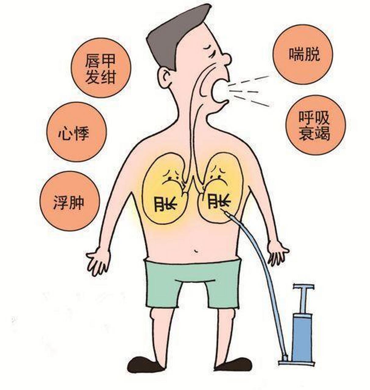 慢阻肺的症状图片
