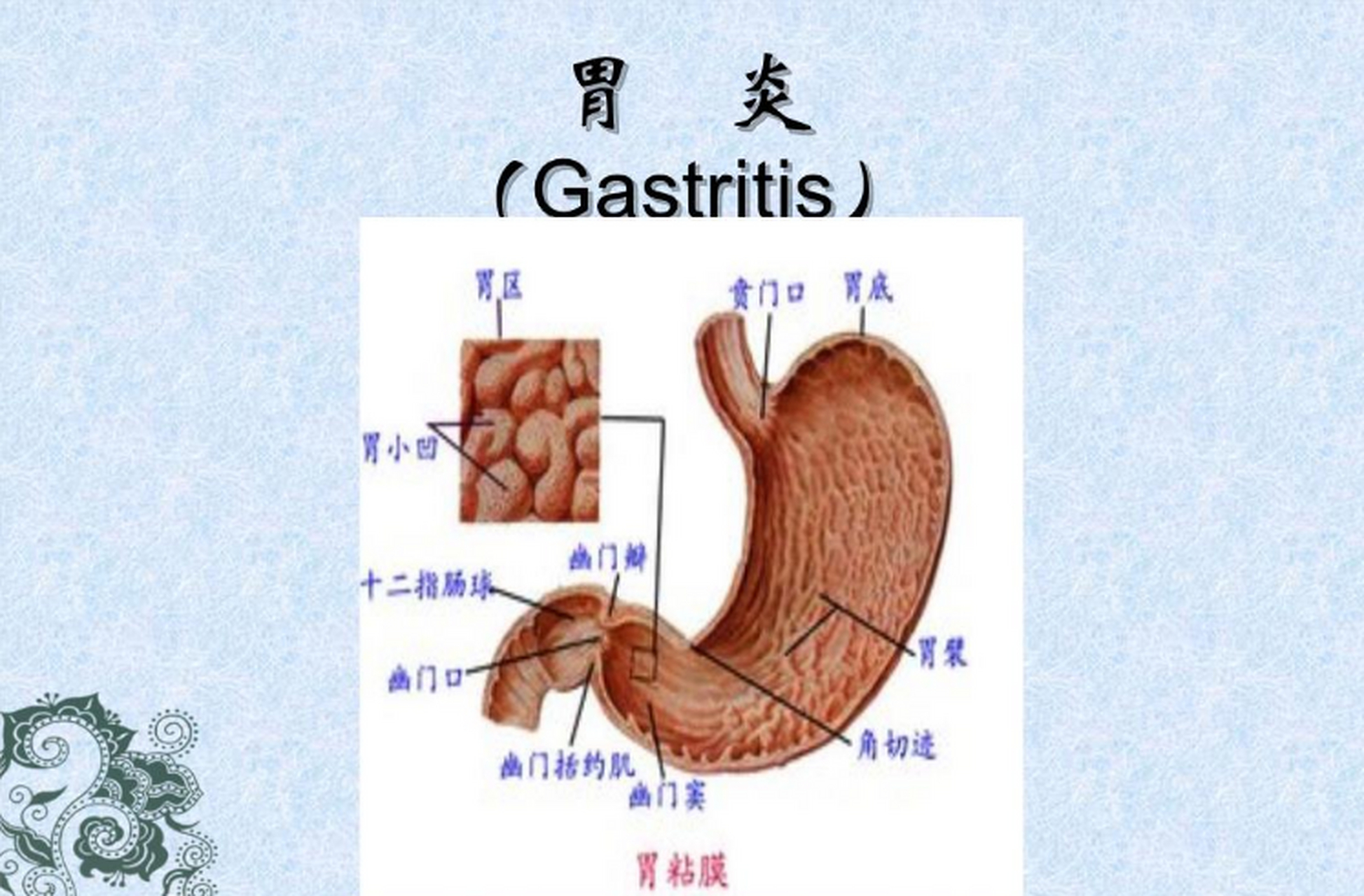 我用一个方子治好了患者多年的慢性萎缩性胃炎   刘某,女,58岁,患慢性