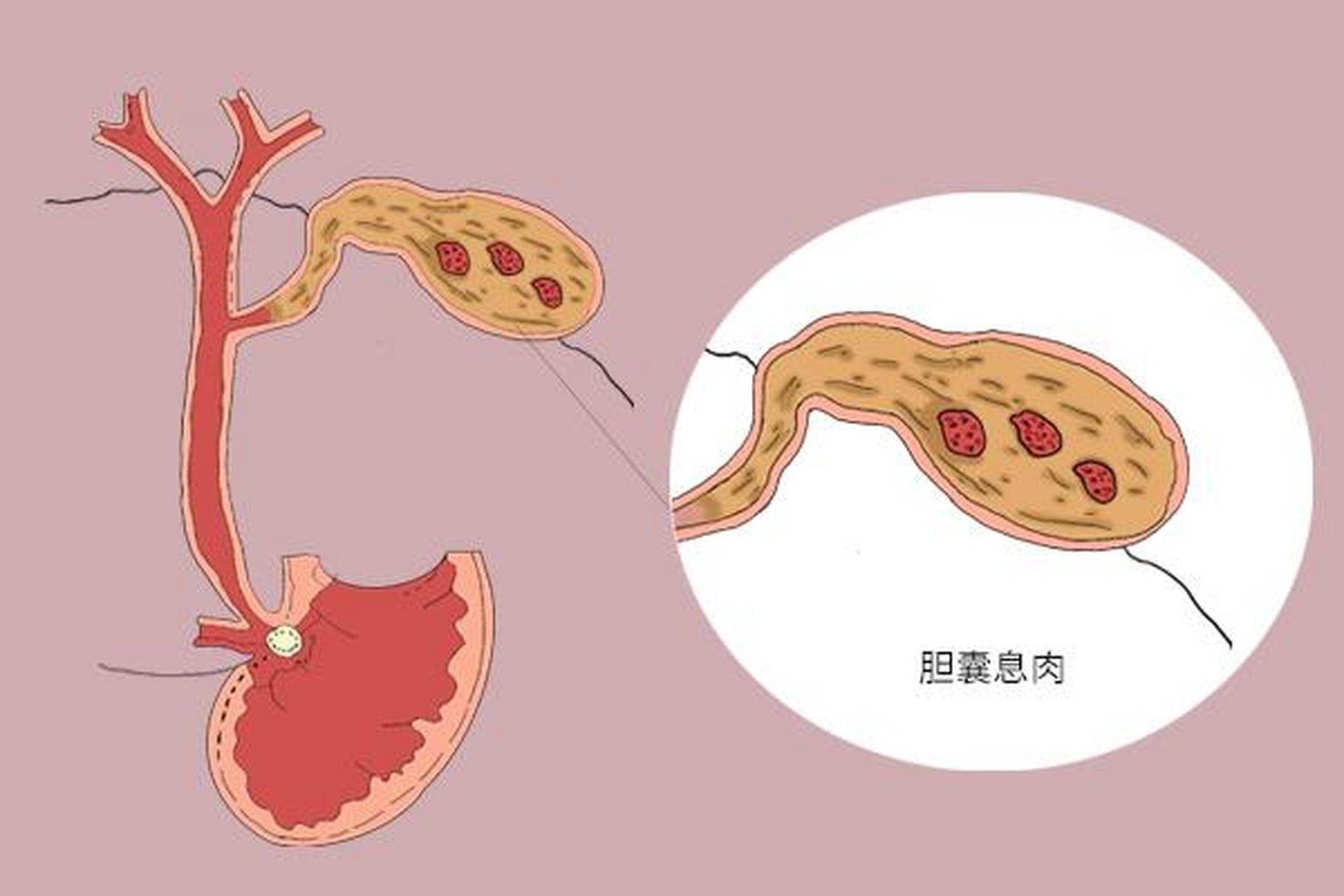 胆囊息肉会右腹胀吗图片