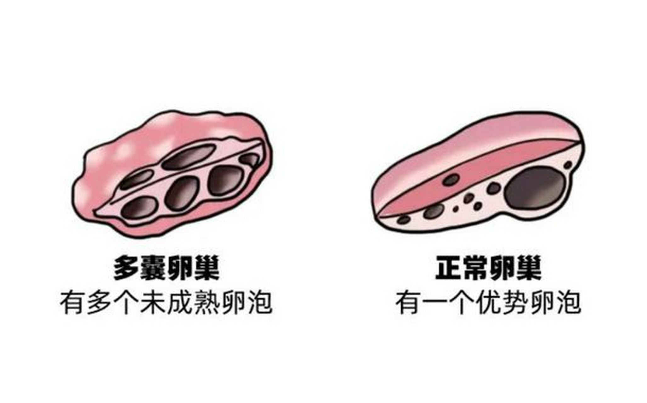 做父母!双侧卵巢多囊样改变严重吗孕妇亲子