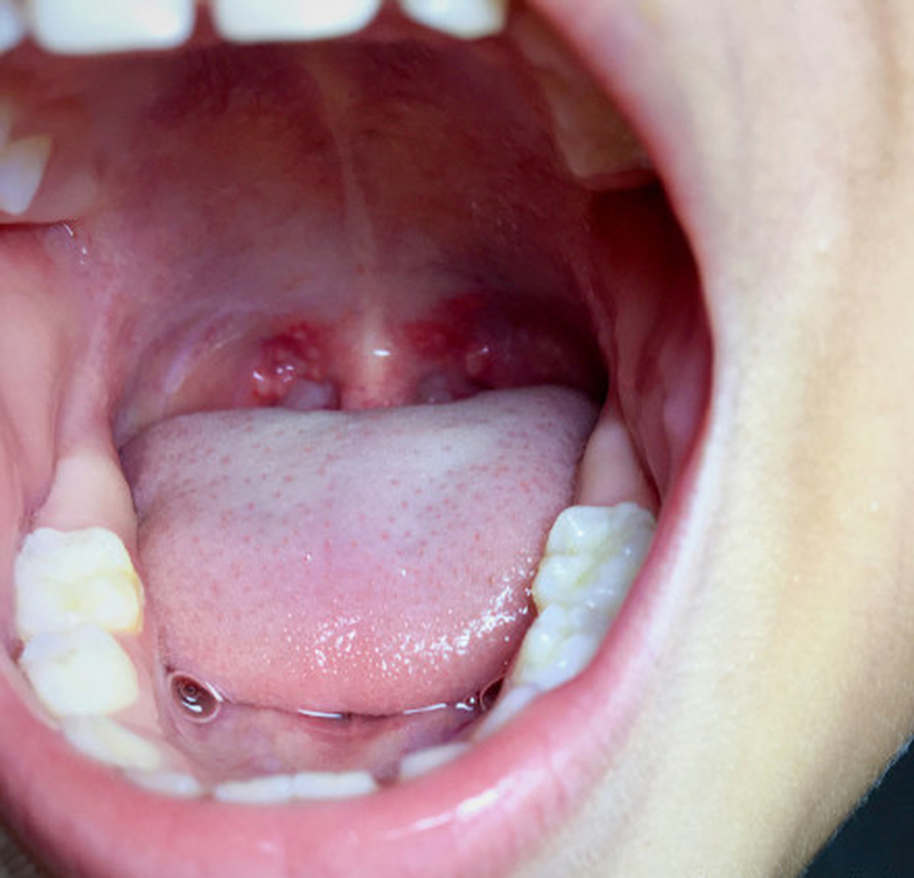 宝宝日记#咽喉里的白点越来越多了,早上看才两个点,难怪睿仔说好痛