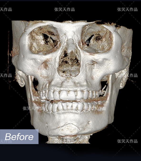 创作人发光计划3# 一组颧骨颧弓 下颌角ct对比 颌骨形态从方形变成