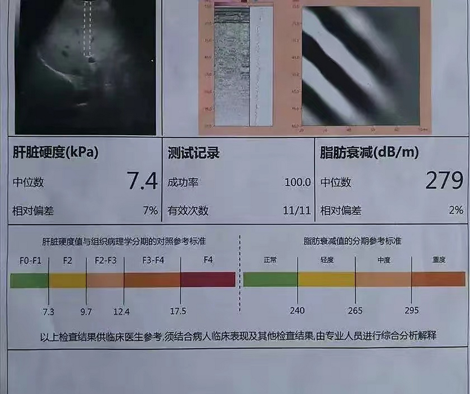 【乙肝患者】洪主任,我患有乙肝肝硬化,現tdf,谷胱甘肽治療中,hbvdna