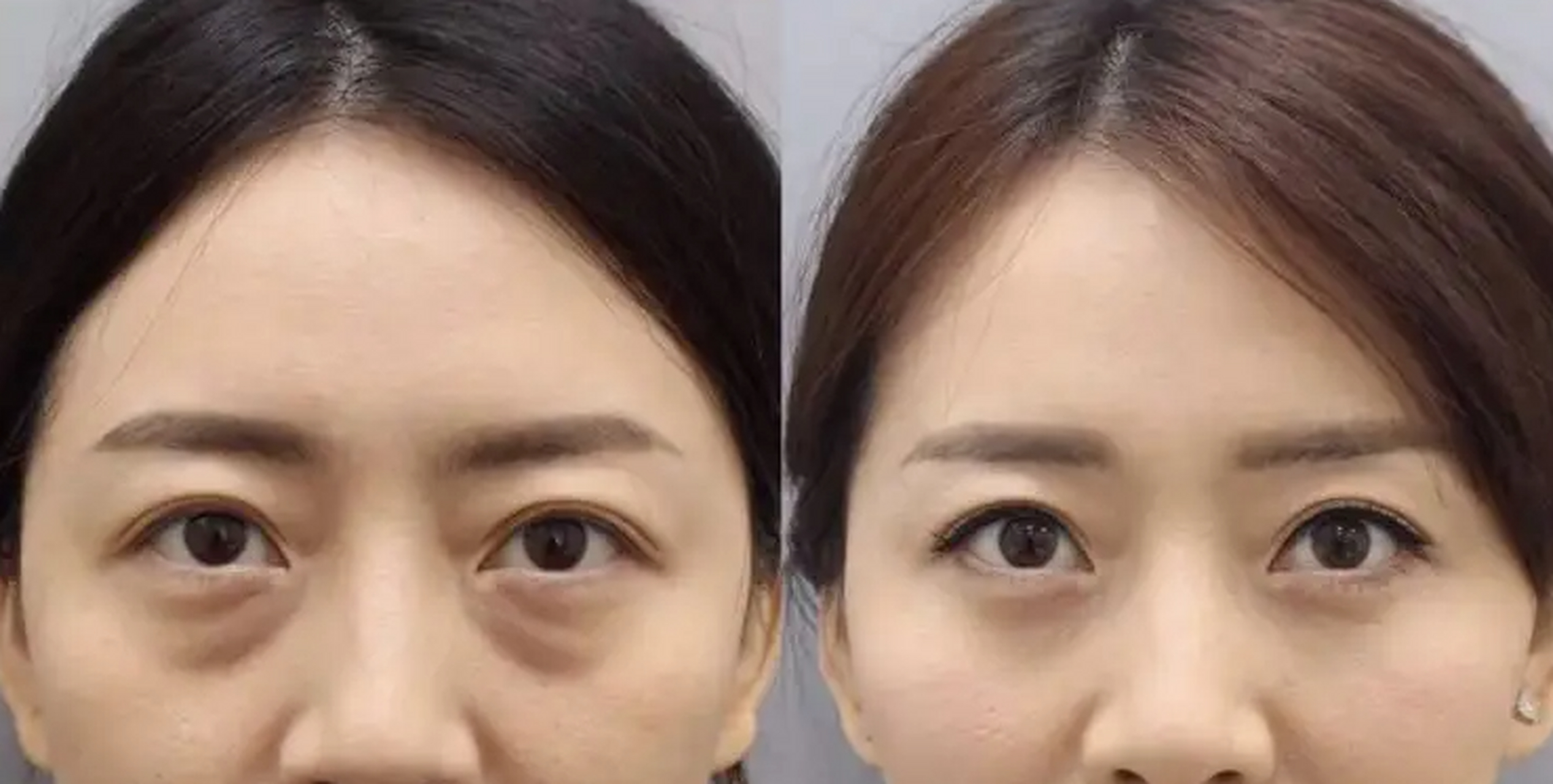 02,睡前喝水会有眼袋 睡前少量喝水,水分大多可以通过肾脏的排泄