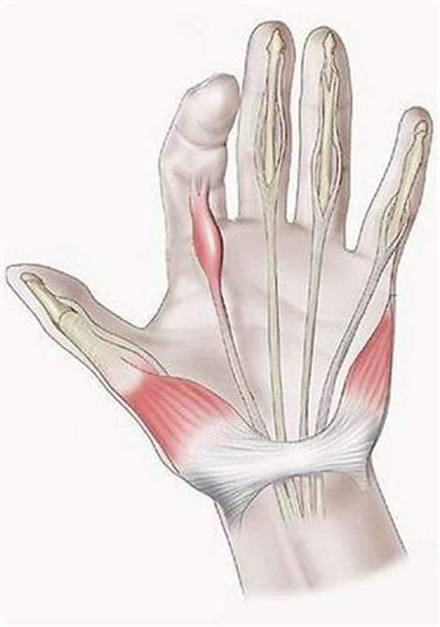 腱鞘炎根治真的不难!关键在于用正确方法!?  本人曾经有过三年腱鞘炎,