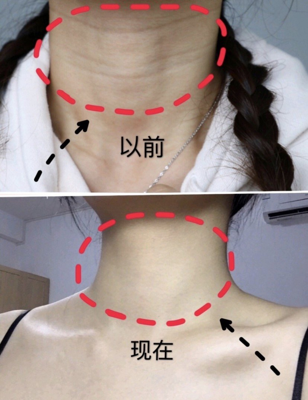 产后颈纹很深怎么消除?  产后颈纹是许多妇女面临的常见问题.