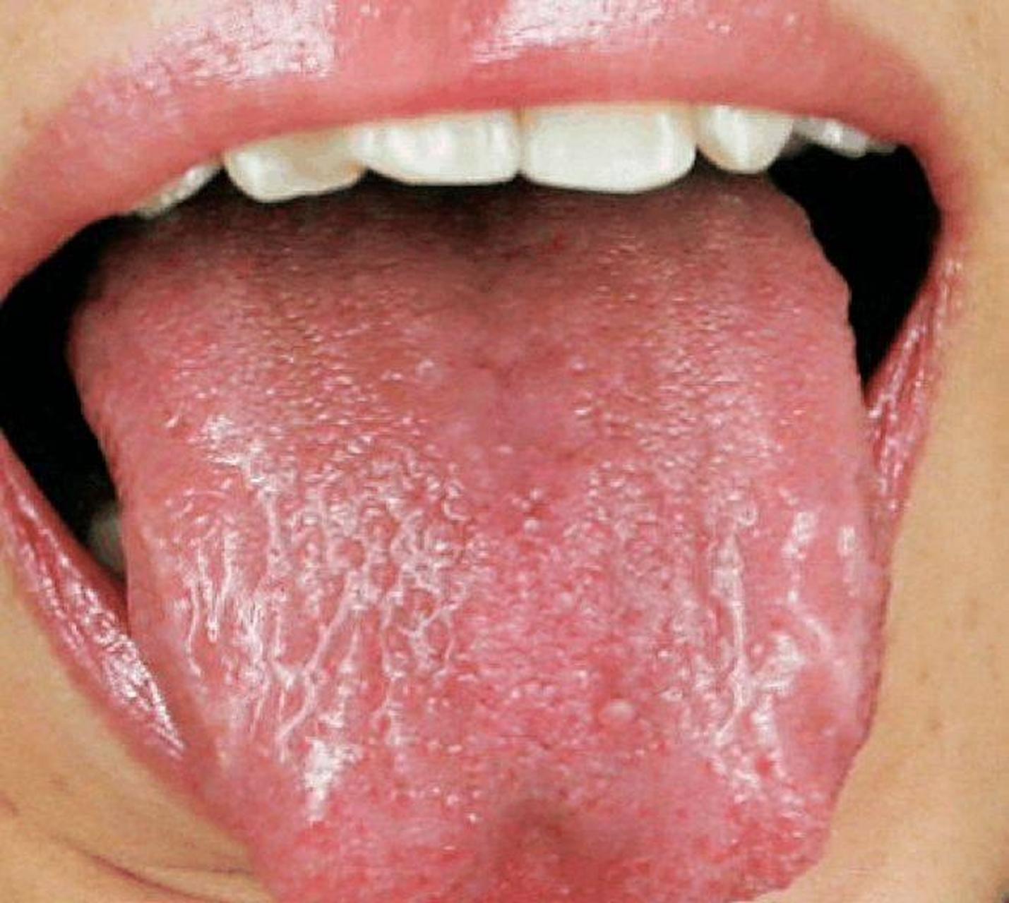 教你从舌象自测肝胆健康  1,肝火旺——舌头两边鼓