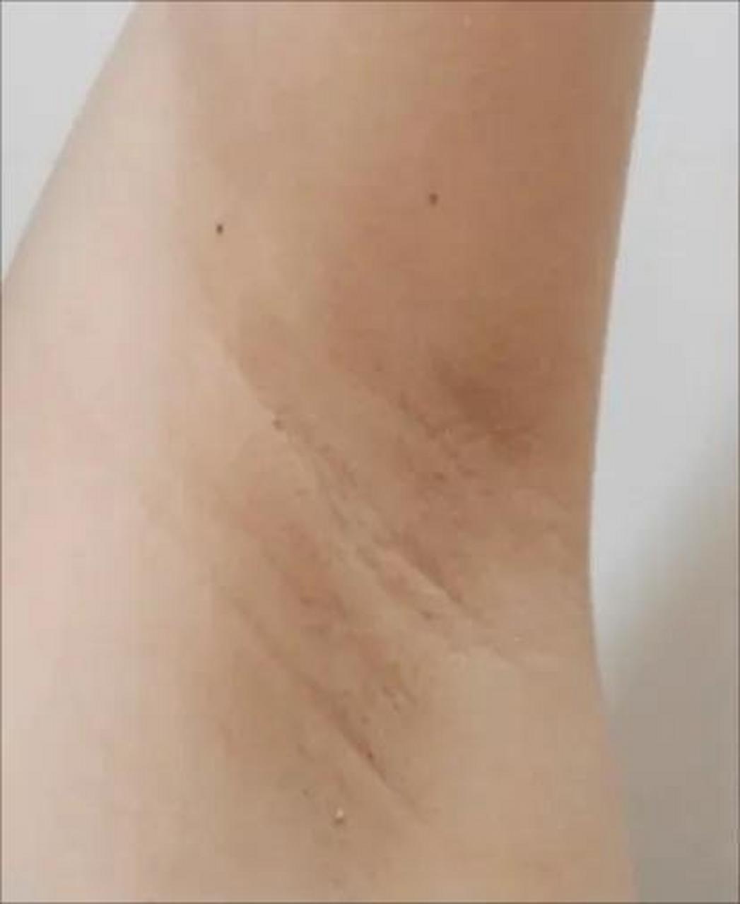 腋下黑很尴尬,教你一招解决  腋毛一刮,发现腋下黑黑的,怎么洗都洗不