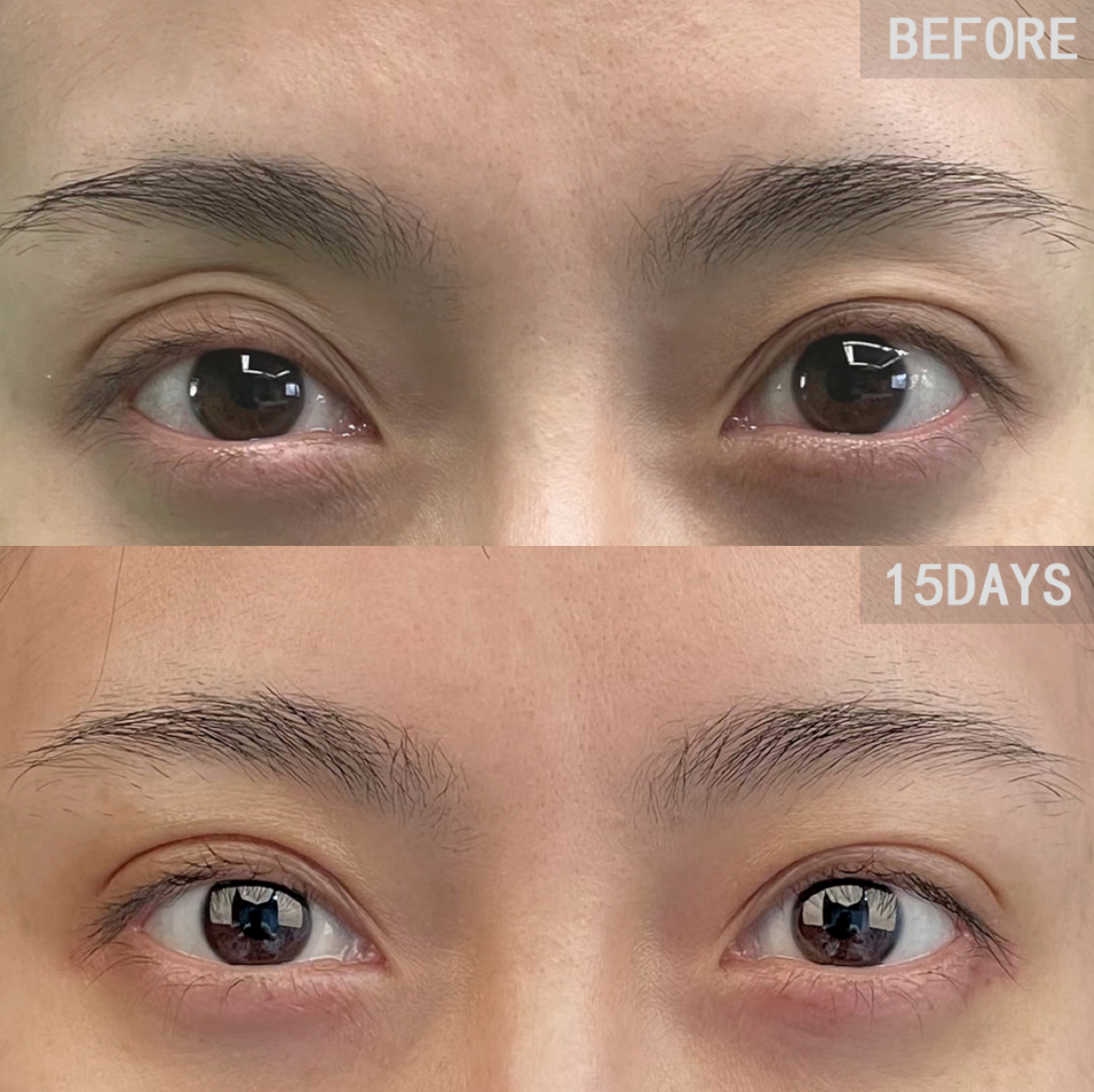 眶隔内有脂肪的!  什么样才算有脂肪?