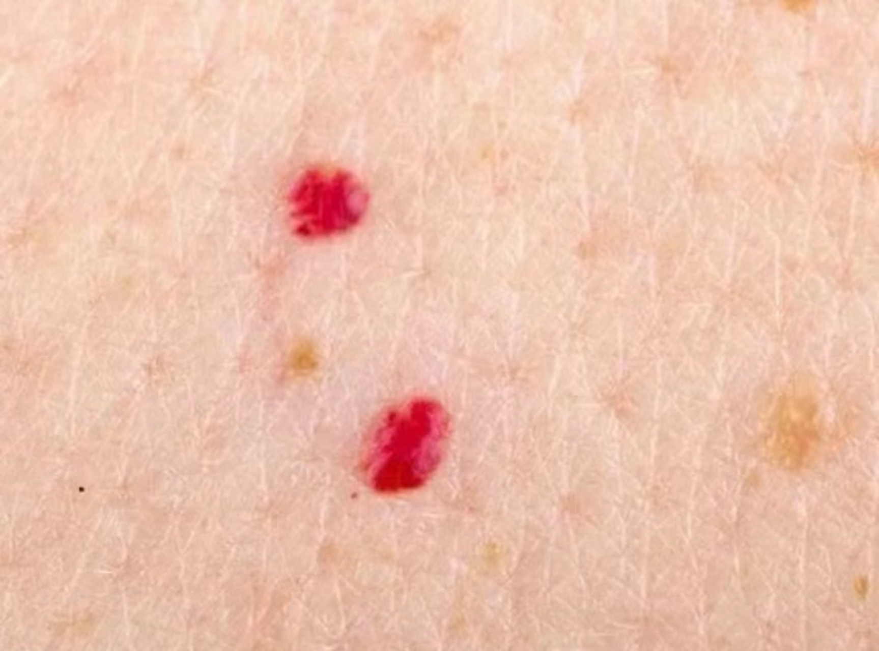 其实这是血痣,  医学上叫"樱桃状血管瘤",也叫"老年性血管瘤"