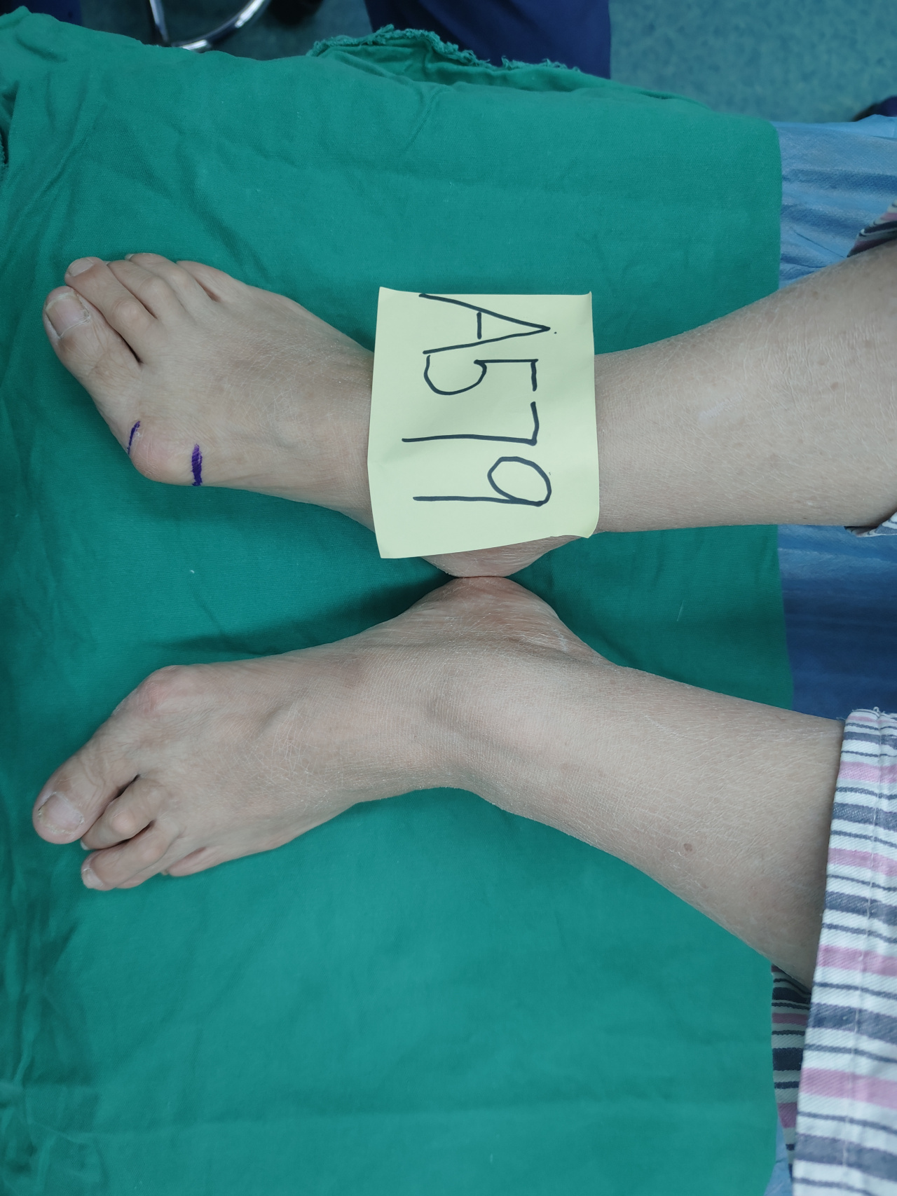93拇外翻是一种足部畸形,通常表现为大脚趾向外倾斜,足弓降低,导致