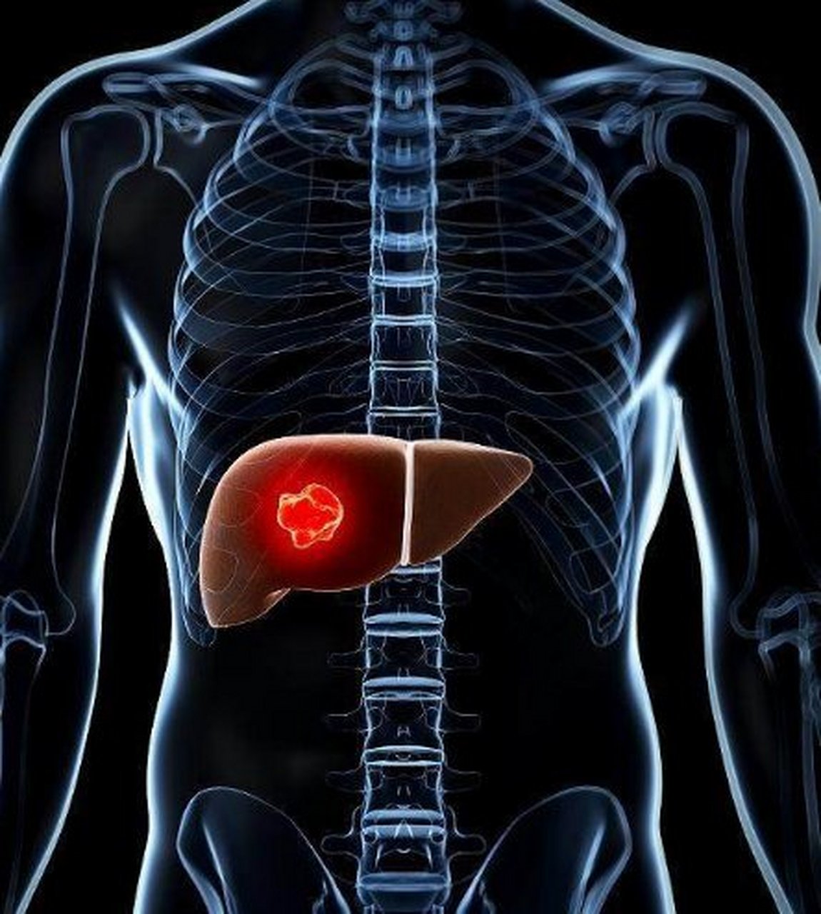 02  肝癌进入晚期,患者极易出现肝腹水,这些患者呢,往往会出现大腹