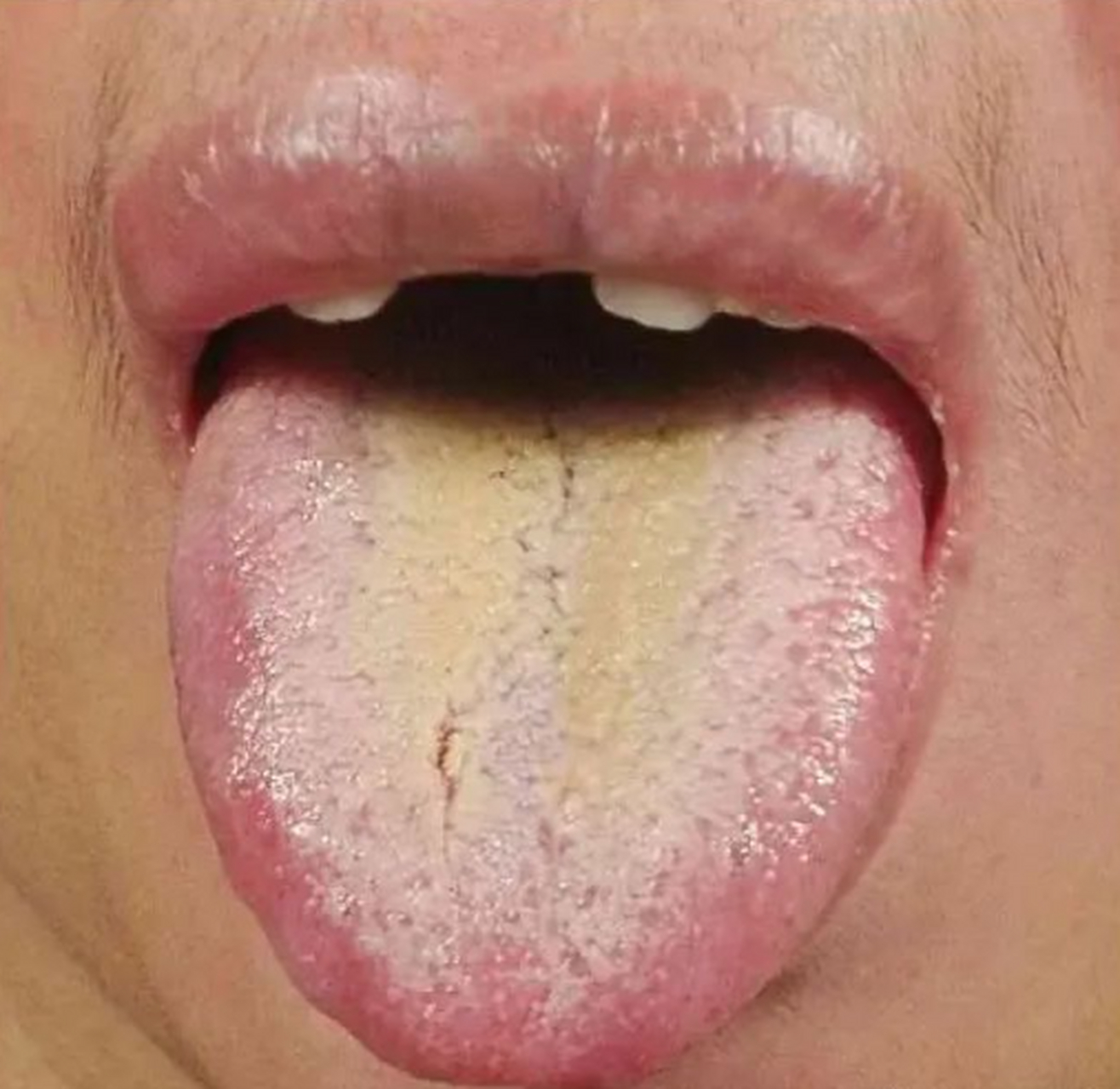 胃脘痛;湿热中阻证 【舌象特征】舌红,舌尖起刺,舌苔黄厚腻,舌根部垢