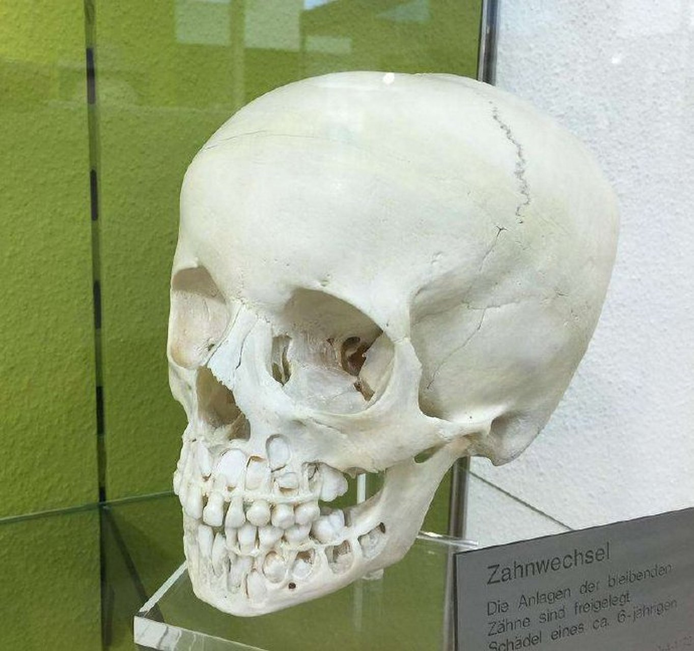 换牙期小朋友的牙片可以清楚看到有四排牙齿 (还有两颗是长在眼睛下方