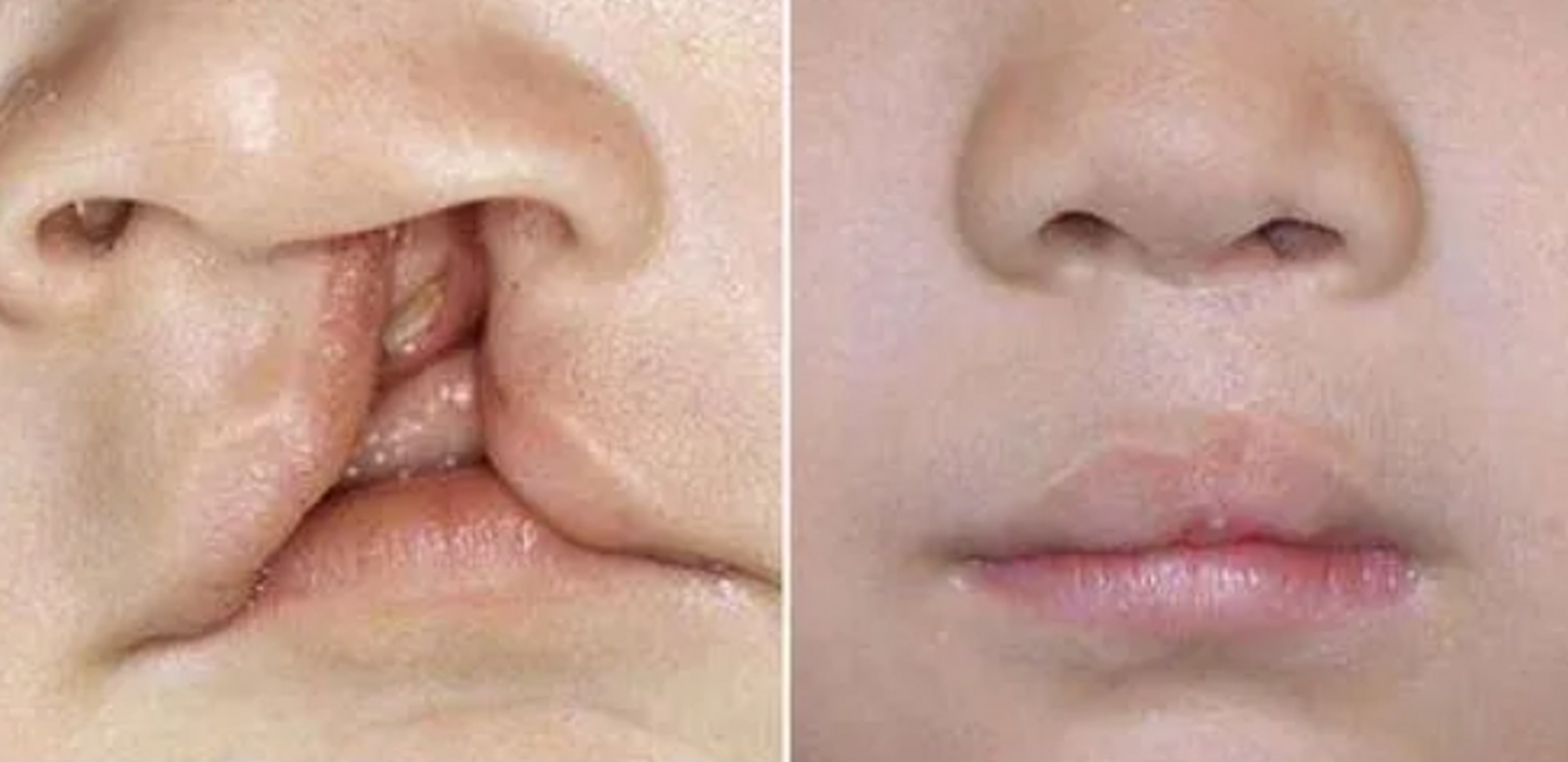 手术的主要目的是改善唇裂畸形患者的外貌,降低其受到歧视和污名化的