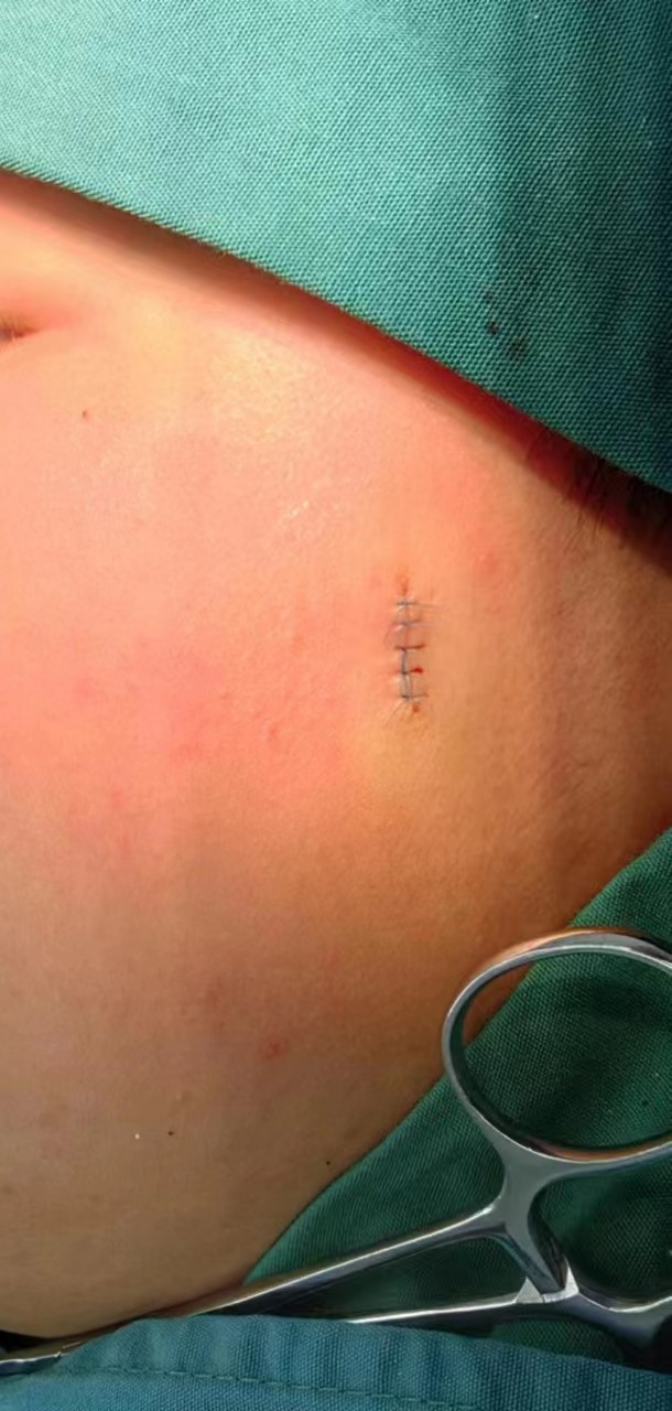 脓性肉芽肿,手术切除后美容缝合#化脓性肉芽肿