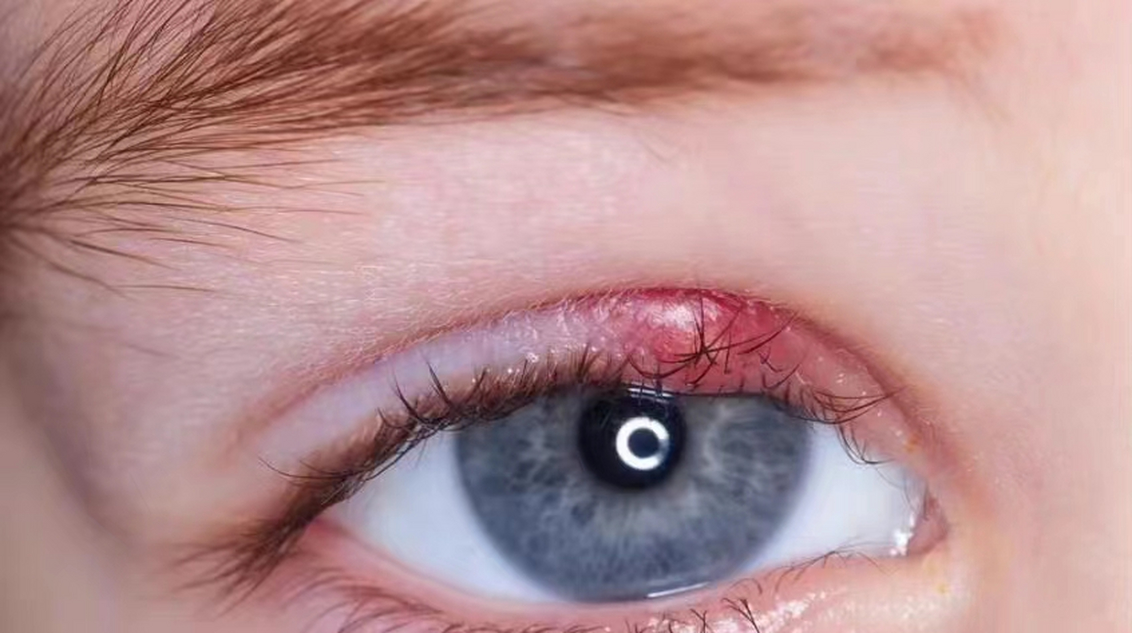 近日,河北邯郸,22岁女生熬夜关灯玩手机后,眼部出现霰粒肿