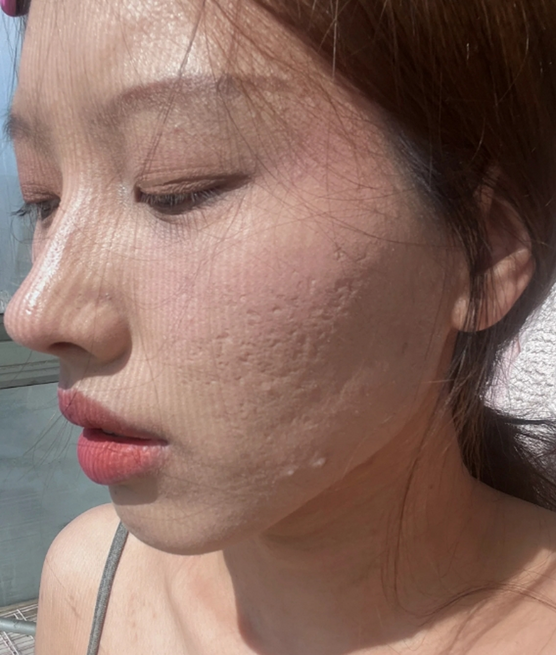 那么,痘坑凹洞能不能修复呢?下面就来详细介绍.