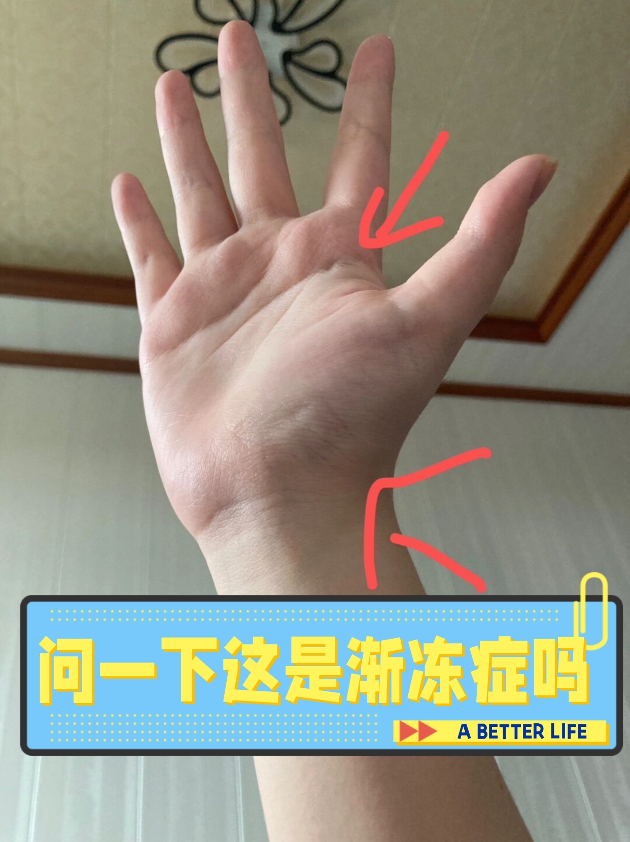 我患有焦虑症,最近我发现手掌有些异样,似乎出现了肌肉萎缩