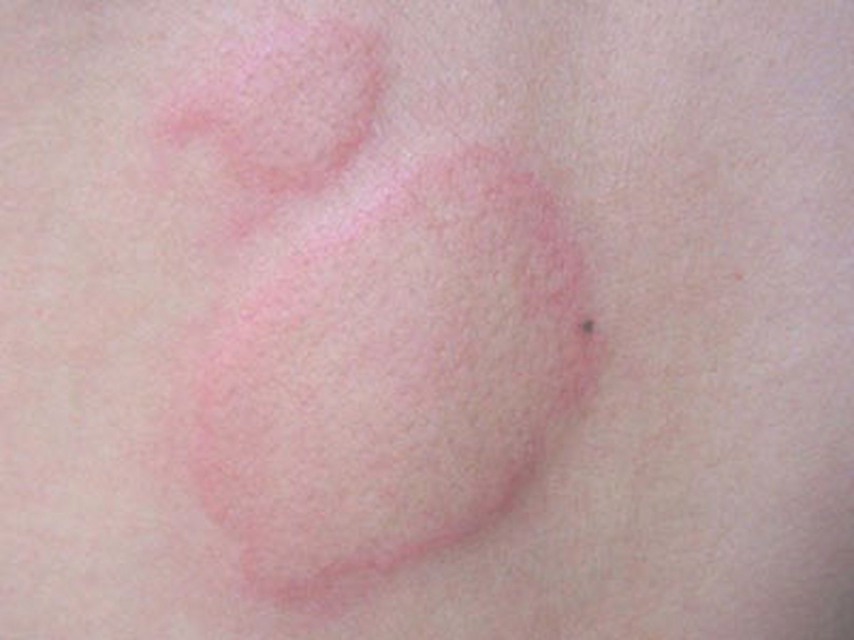 胆碱能性荨麻疹的核心病因是什么?