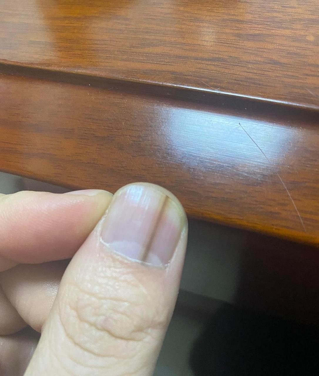 网友:大拇指甲上长了一条黑线,这是怎么回事呀?