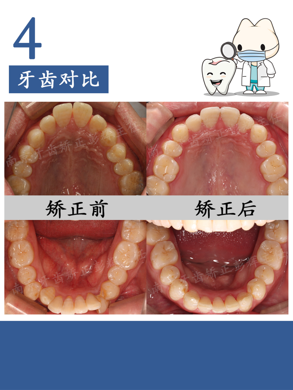 牙齿深覆合和深覆盖图片