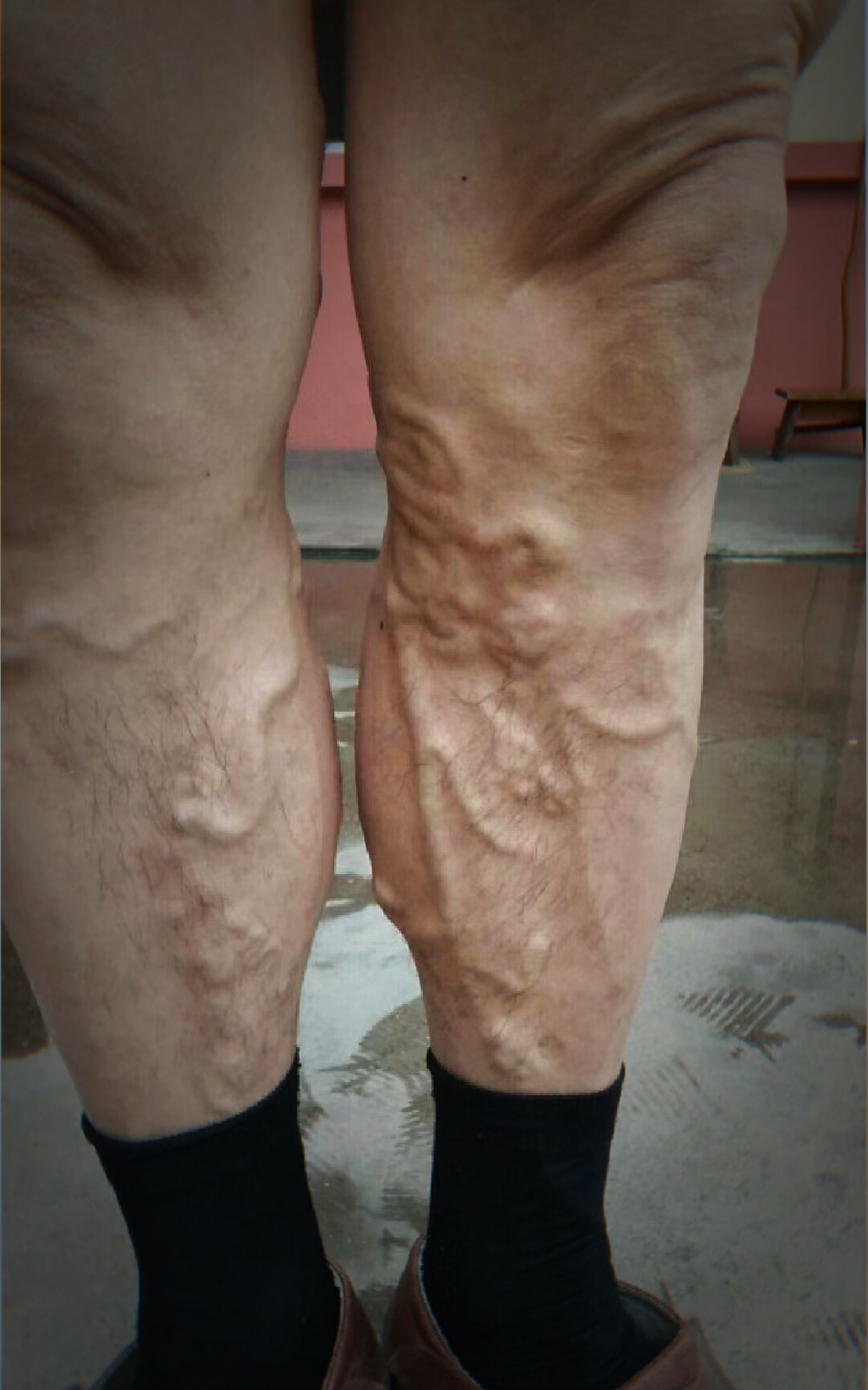 张先生的静脉曲张,已经30多年了,因为没什么特殊的不舒服,所以一直也