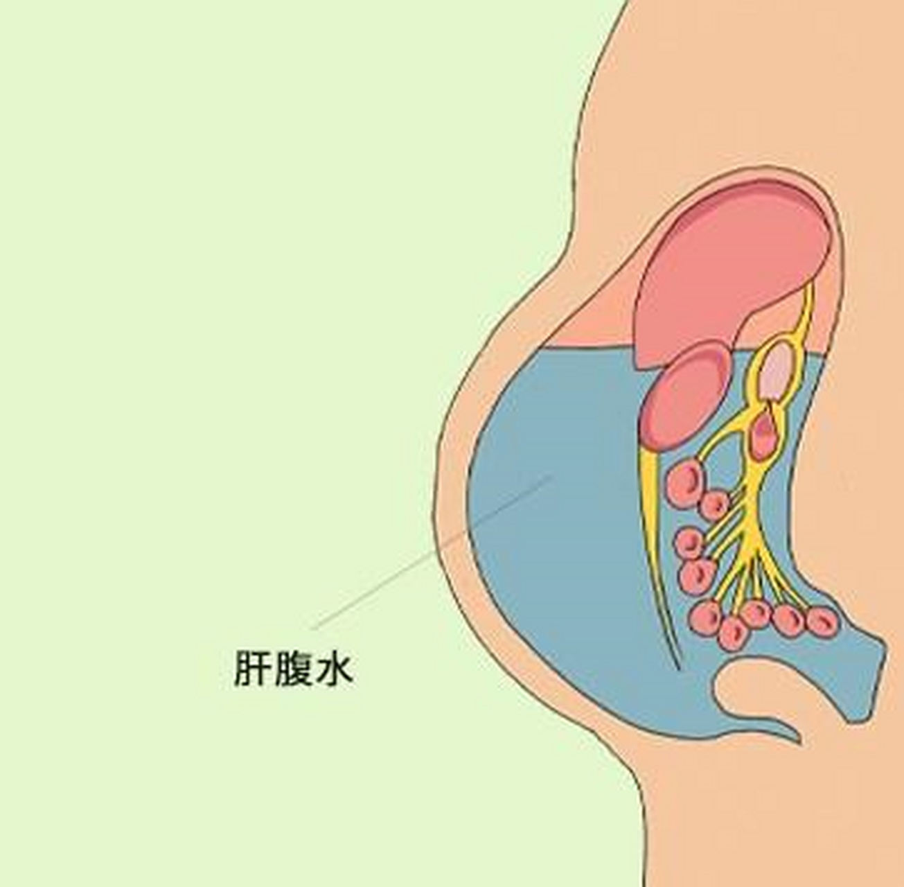 腹水卡通图片