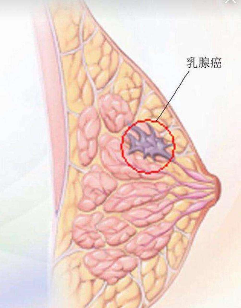 乳腺囊肿的症状图片