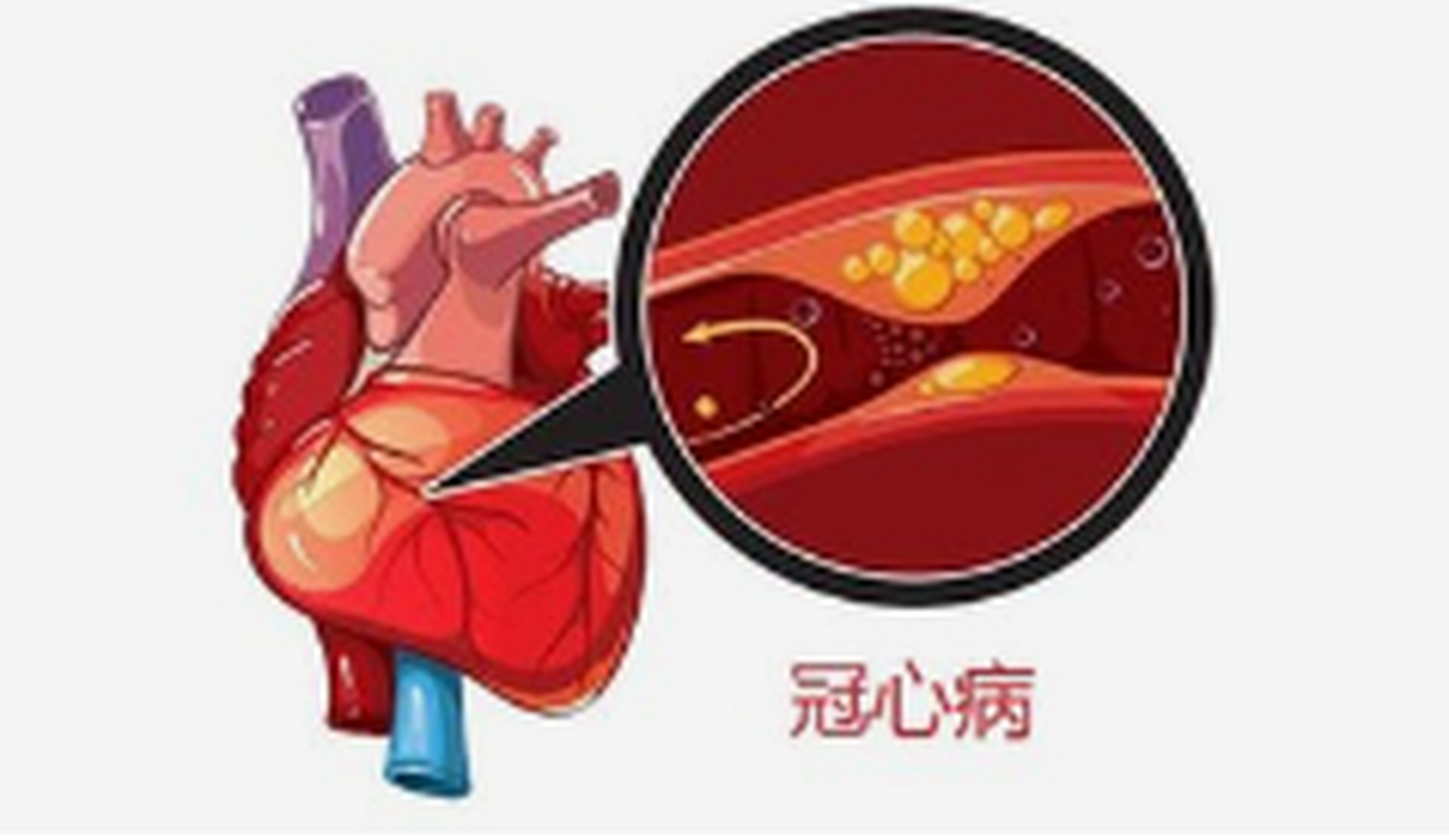 冠心病分类图片图片