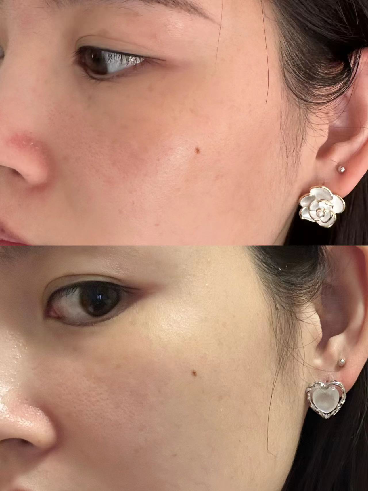 做水光 最近出游玩回来之后发现脸上的晒斑更明显啦肤色也有些暗沉