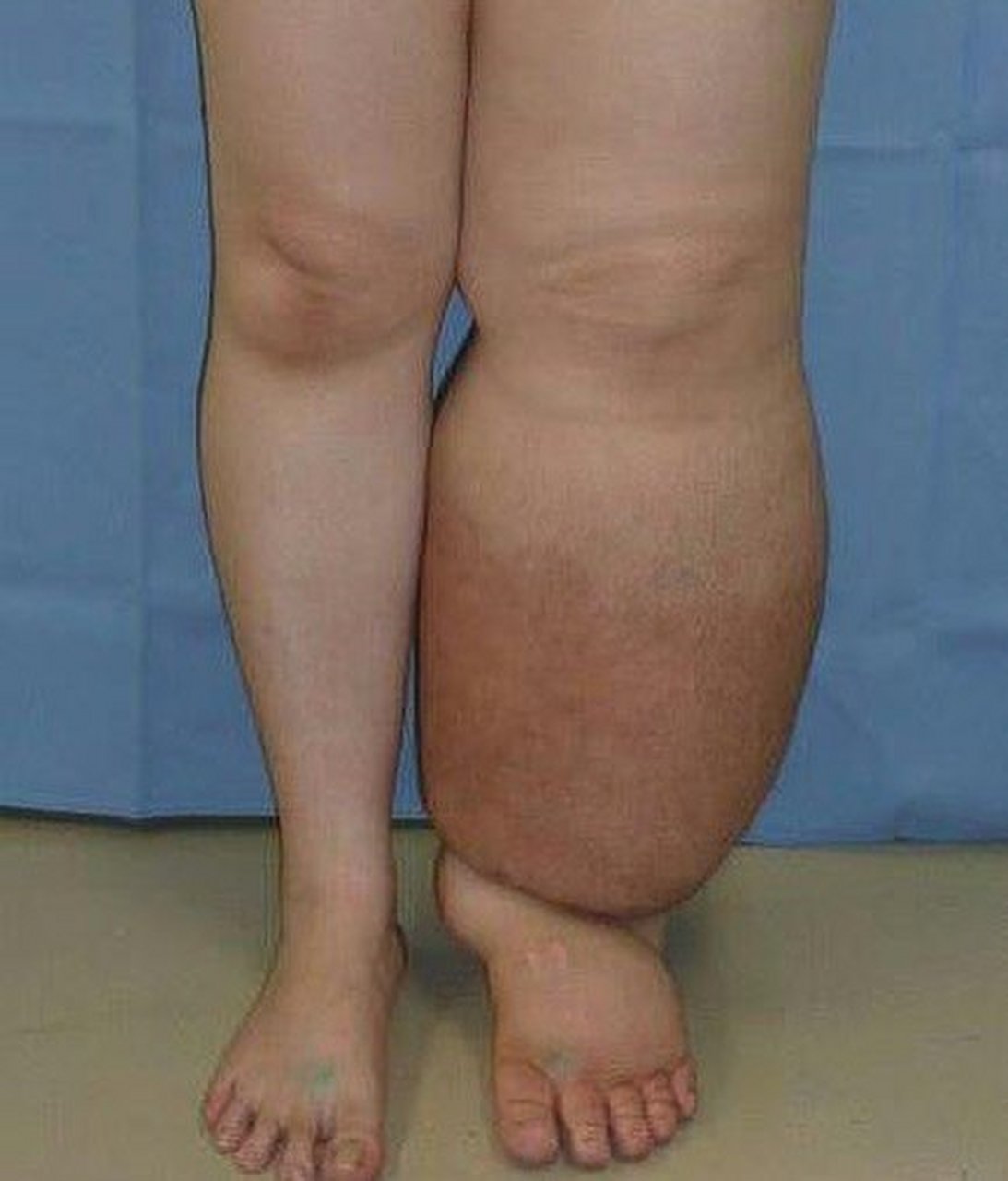 【象皮病】又称血丝虫病,是因血丝虫感染所造成的一种症状,血丝虫幼虫