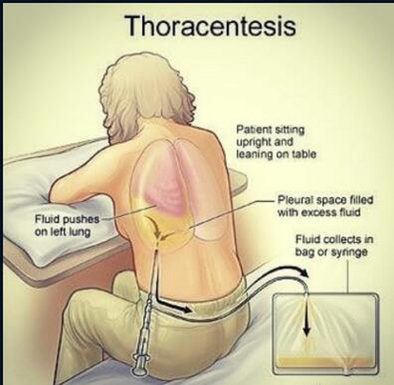 【胸腔穿刺术】也被称为胸腔穿刺-胸膜穿刺,针状胸腔造口术,或针头