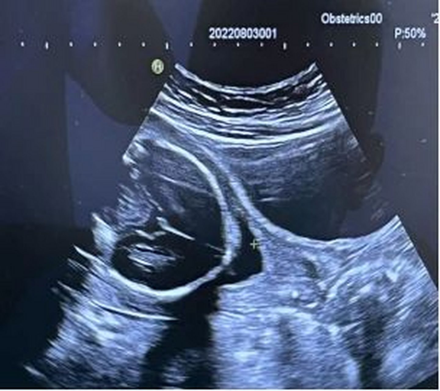 孕27周的张女士在孕24周时在外院四维彩超发现宫颈内口呈"v"型扩张