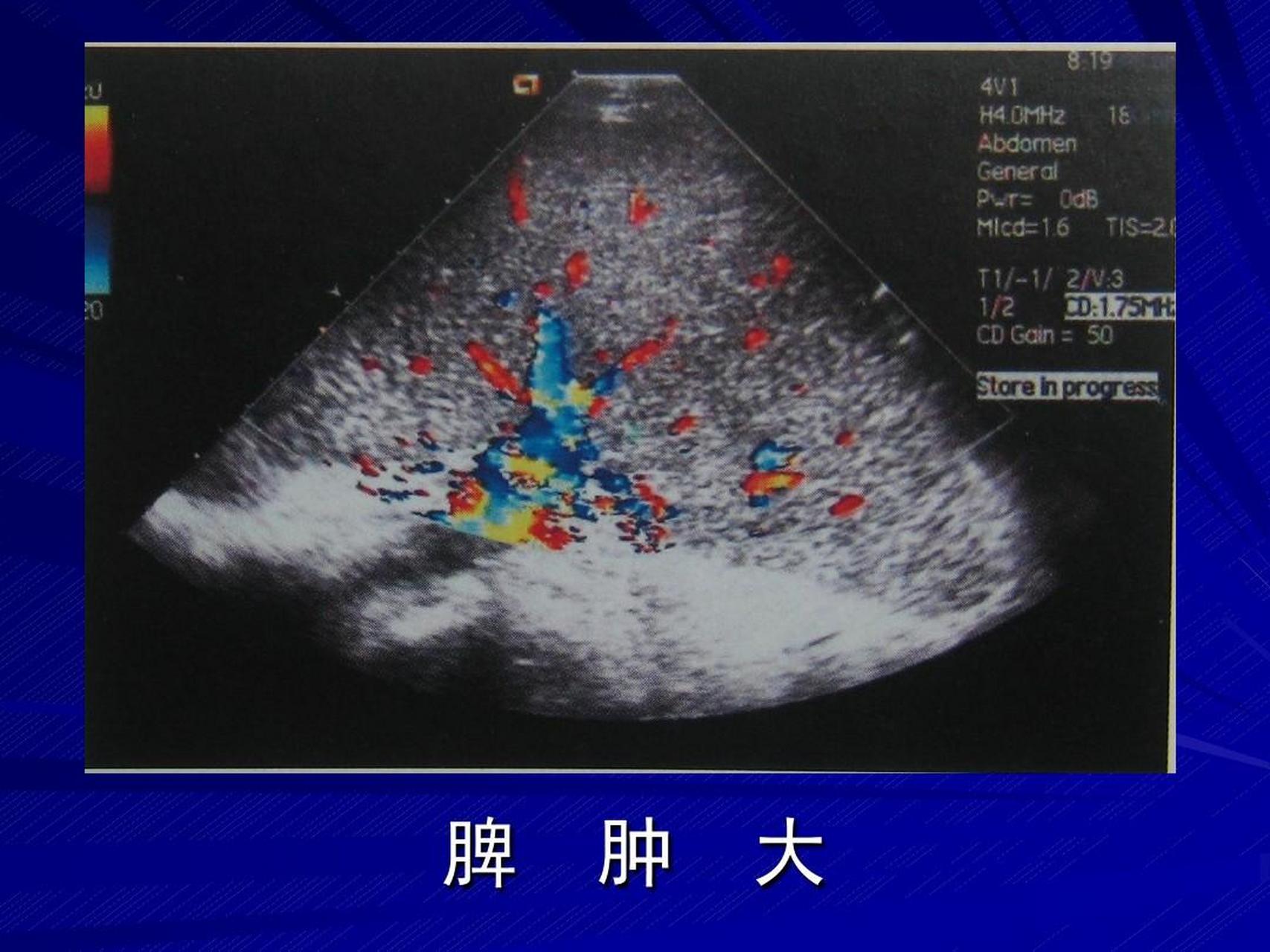 贫血    脾肿大和血液病有非常大的关系,所以身体出现这些反应时,一定