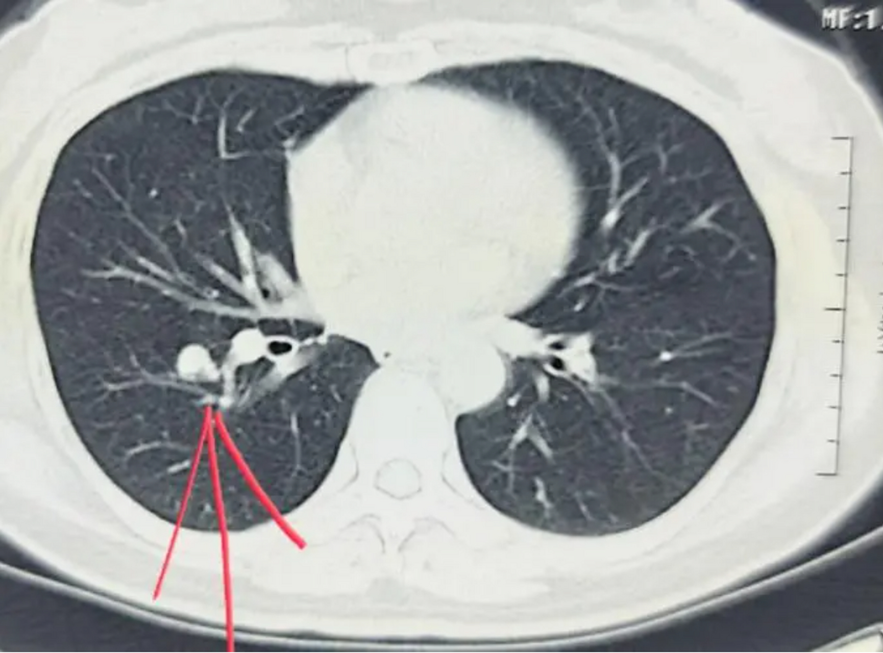 11个肺ct报告的潜台词,看一遍就能懂 1,纤维灶:一般指良性病变,指曾经