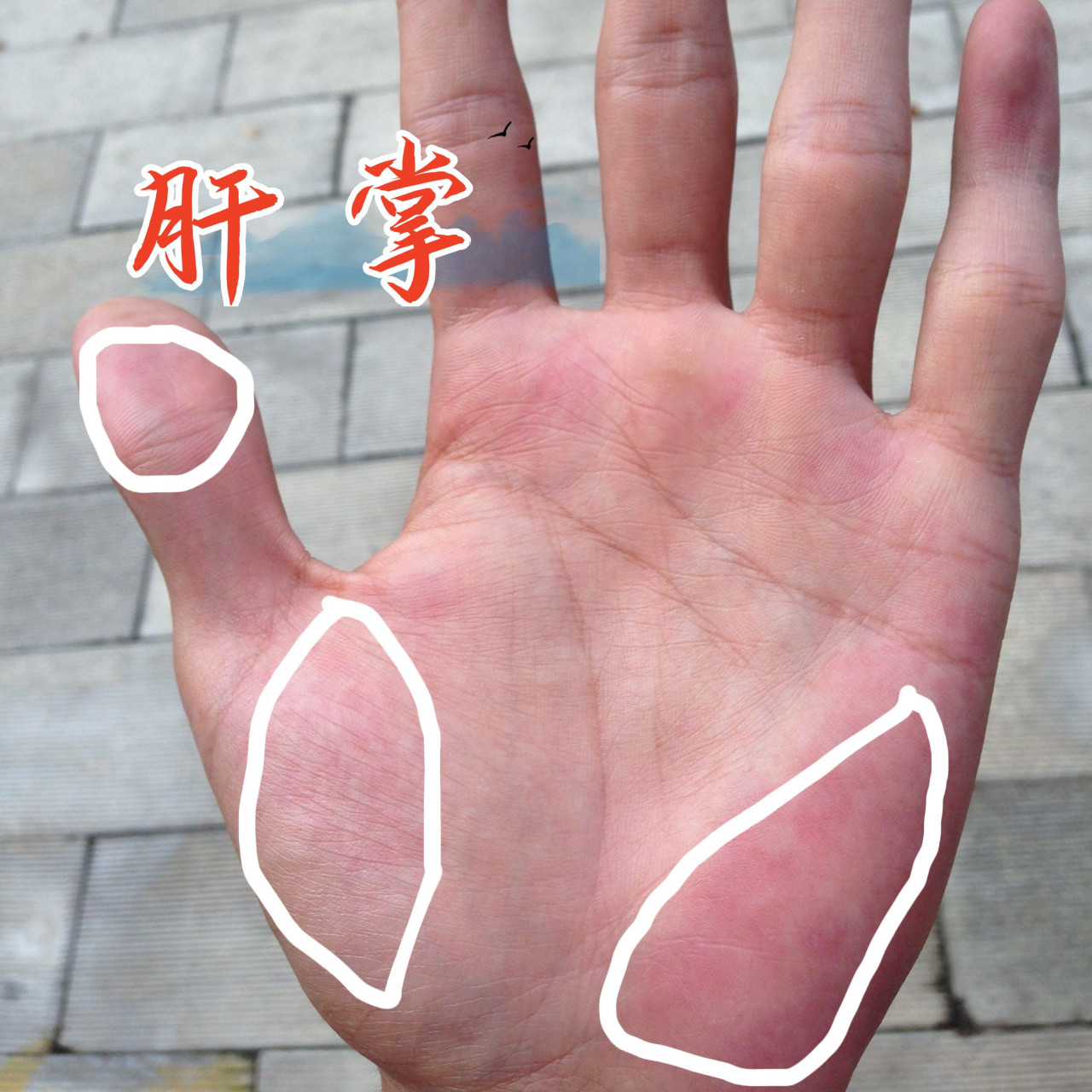 肝掌也称为"掌红".