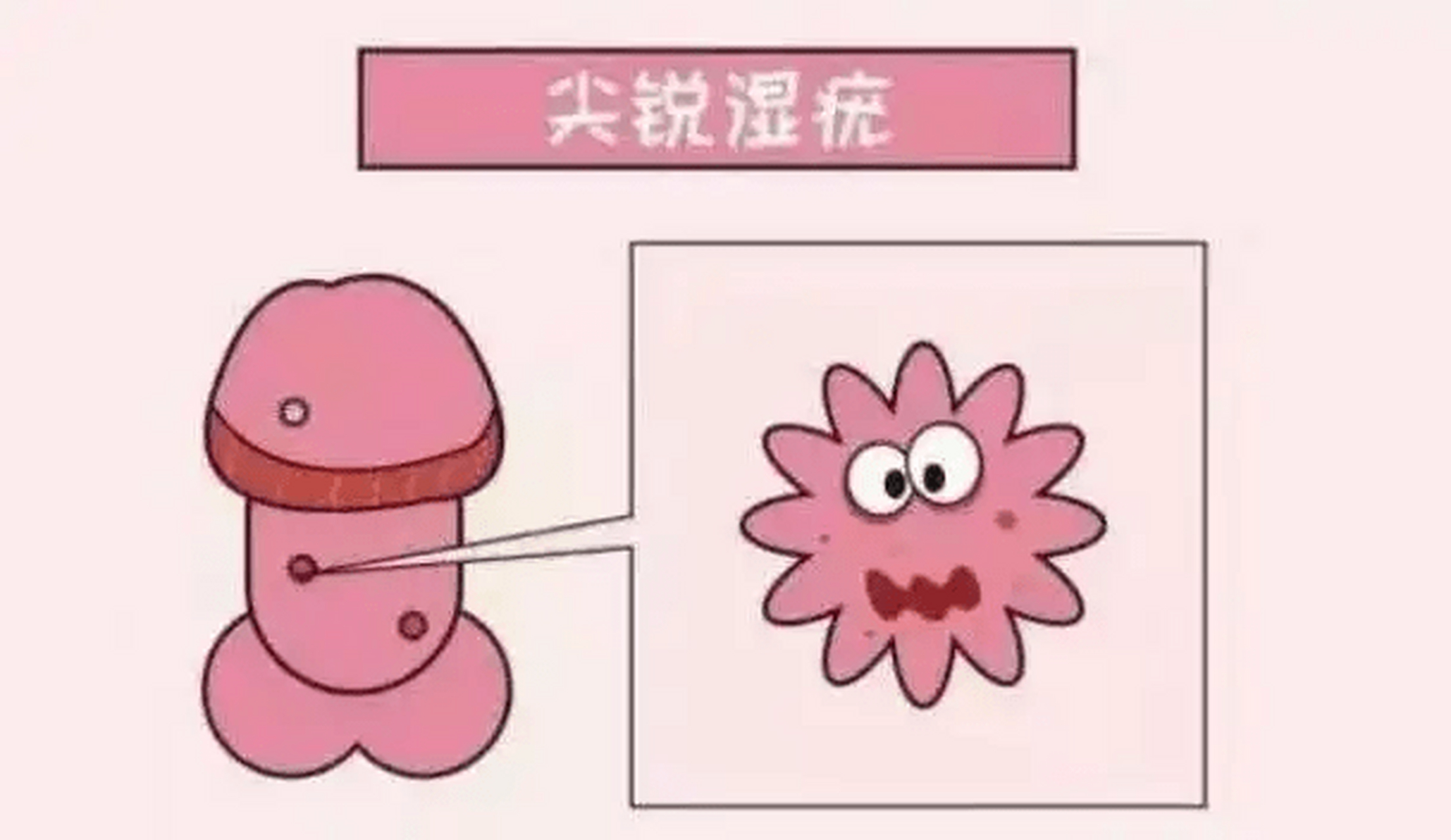 hpv是"人乳头瘤病毒"的简称,研究表明,绝大部分的宫颈癌与hpv 感染