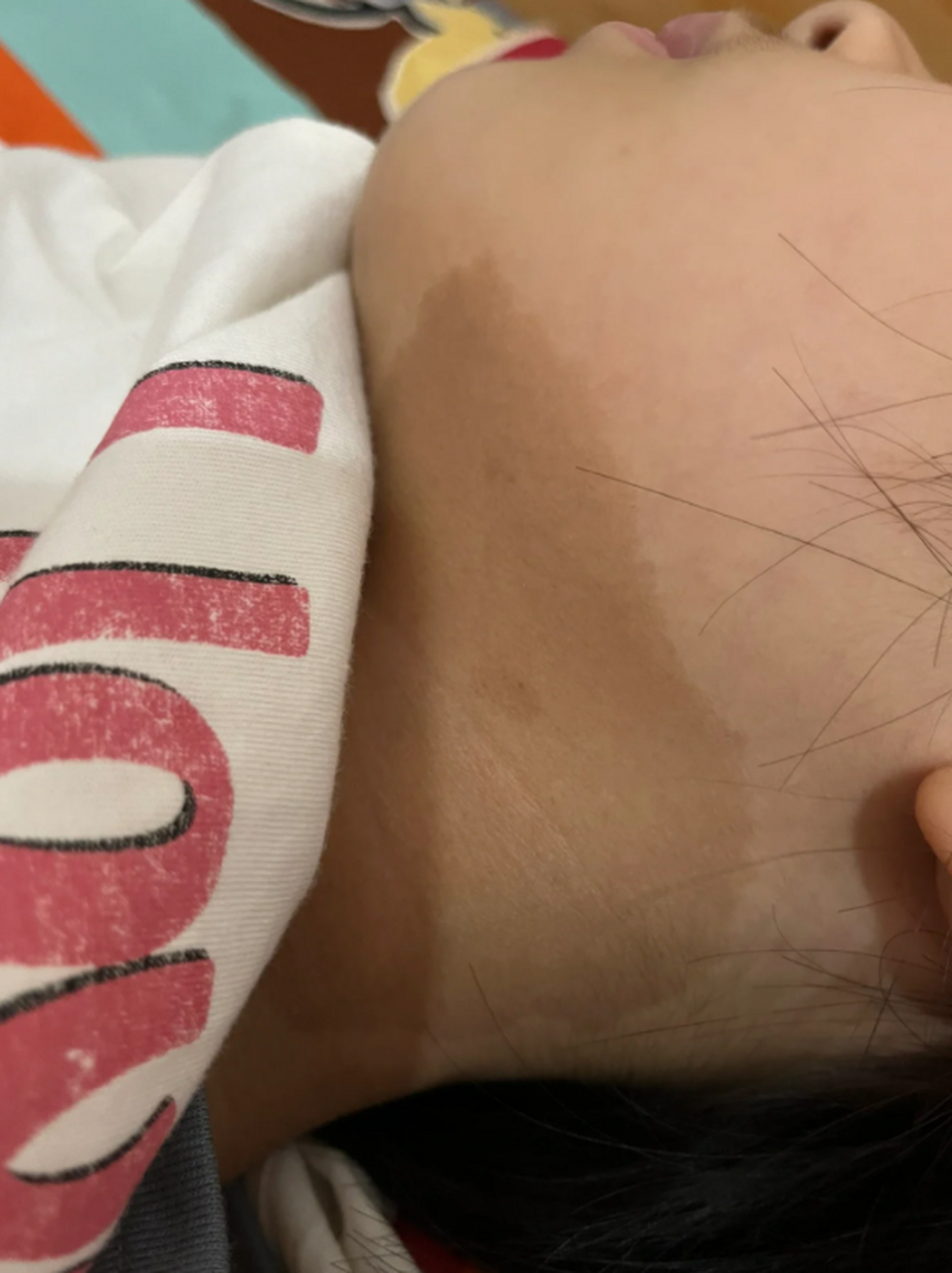 脖子上的咖啡斑是一种常见的皮肤问题,给人们的外貌形象带来不小的