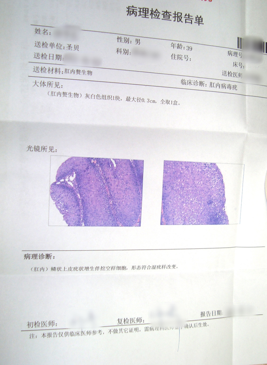 肛内尖锐湿犹图片