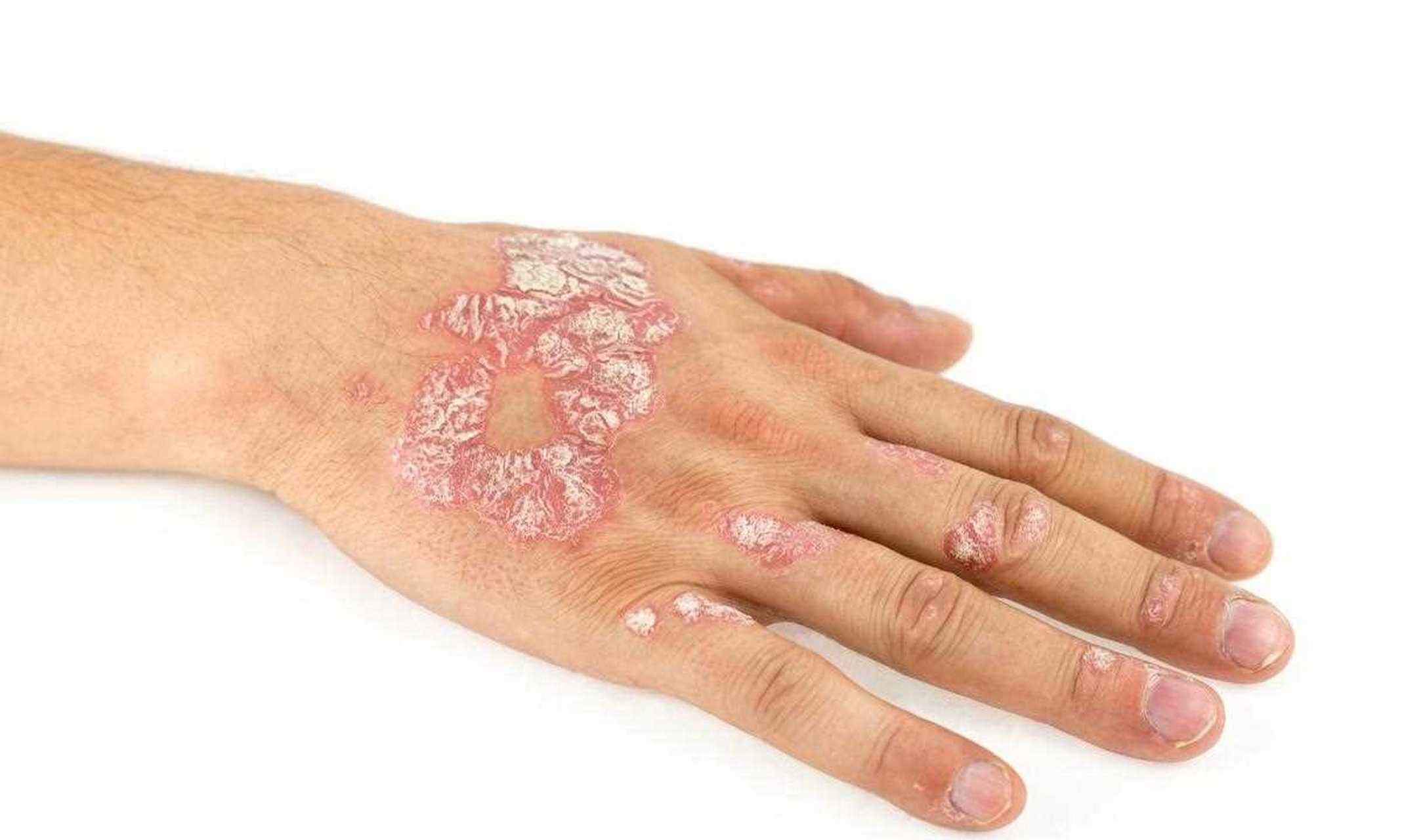 后背的牛皮癣有办法治好吗? 面对牛皮癣这种顽固的皮肤病,很多患者朋