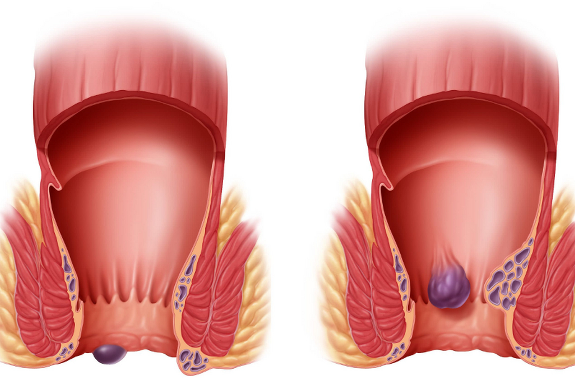 "肛门痒"是一个尴尬又烦人的症状,它可能源自多种原因,比如肛门湿疹