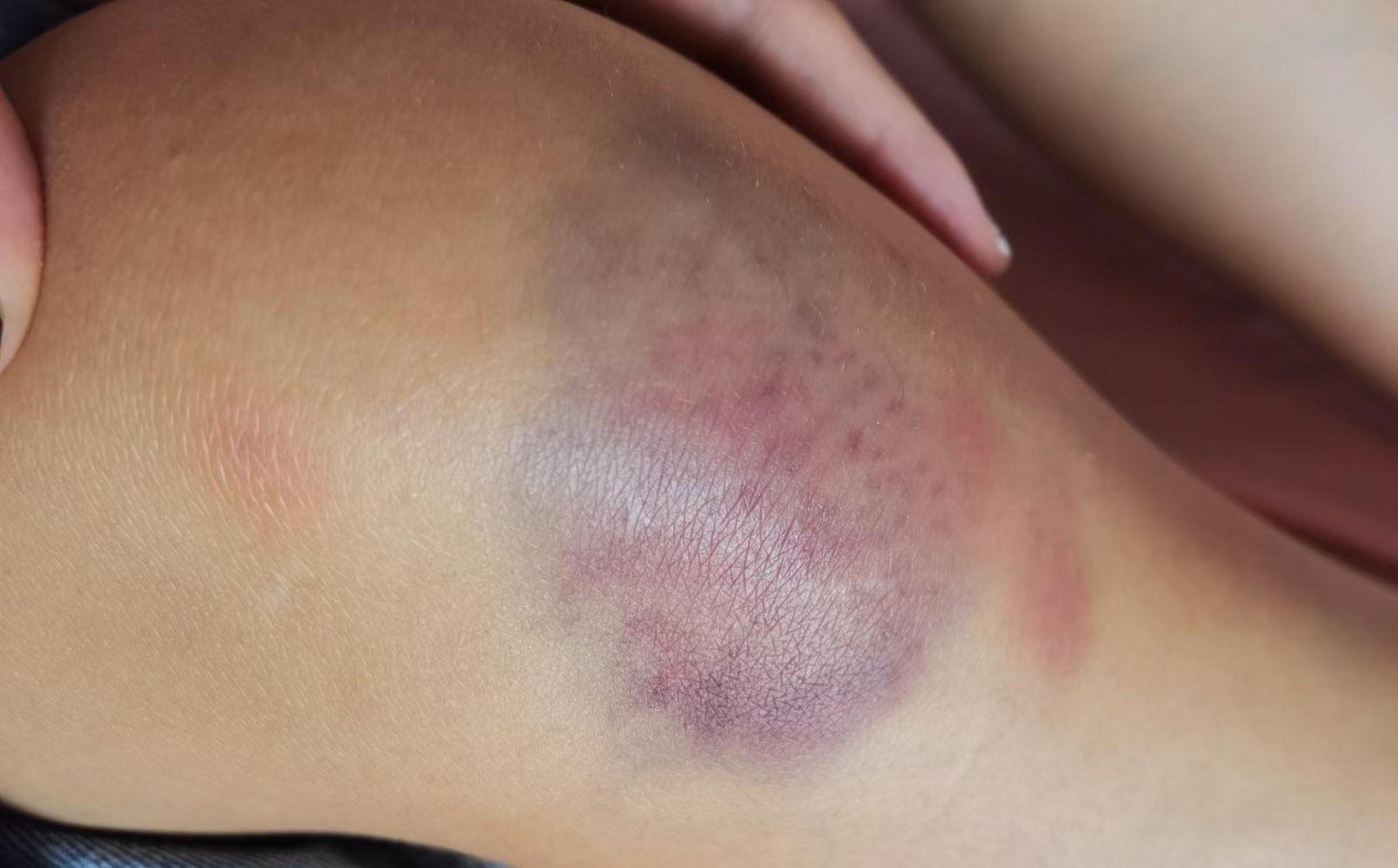 同事女朋友去长沙玩了一个星期,回来说腿摔了,同时拿来问我,我该怎么