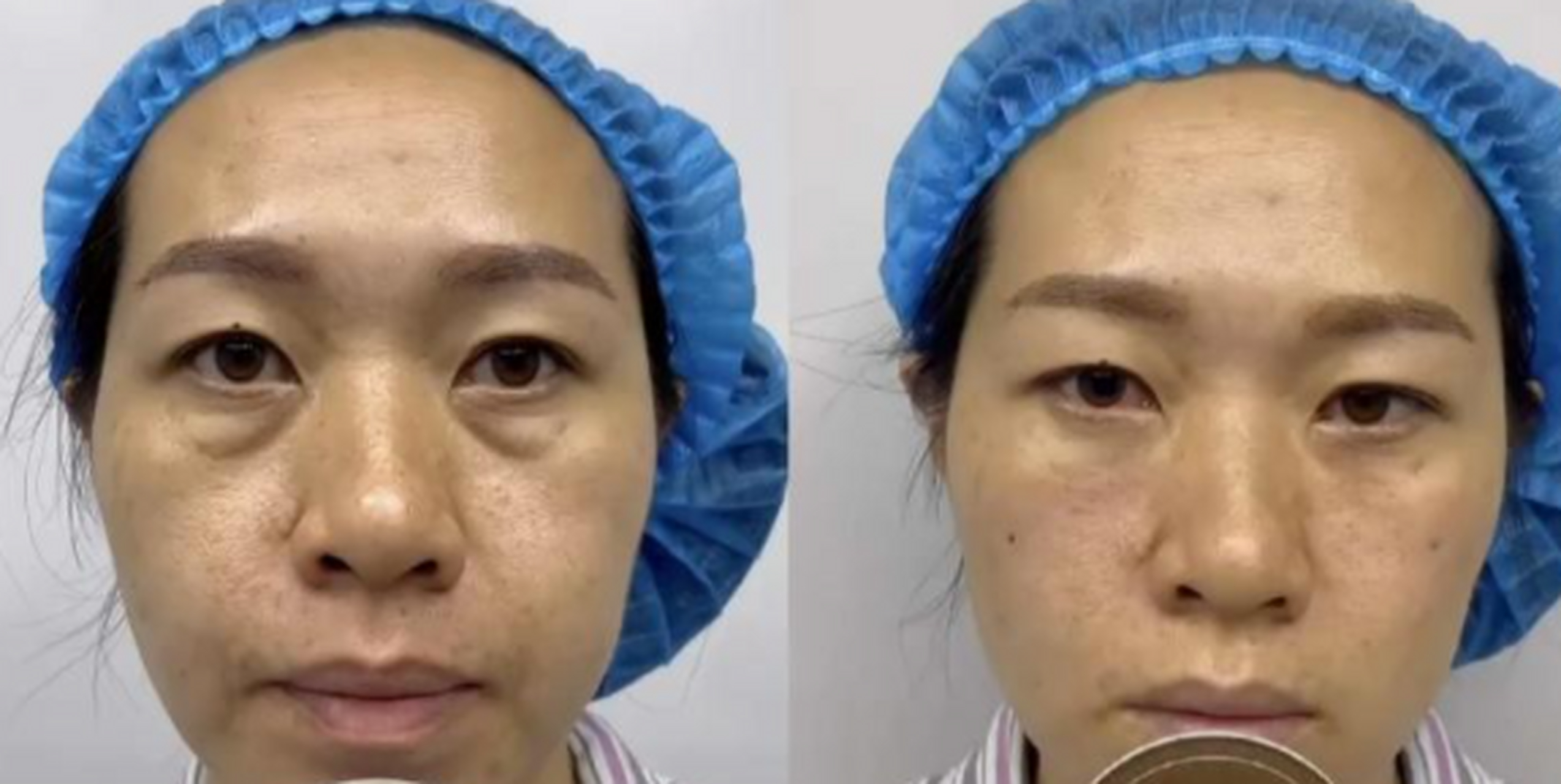 从下图可以看出,这位患者的眼袋呈倒三角,导致泪沟凹陷深,非常的显老