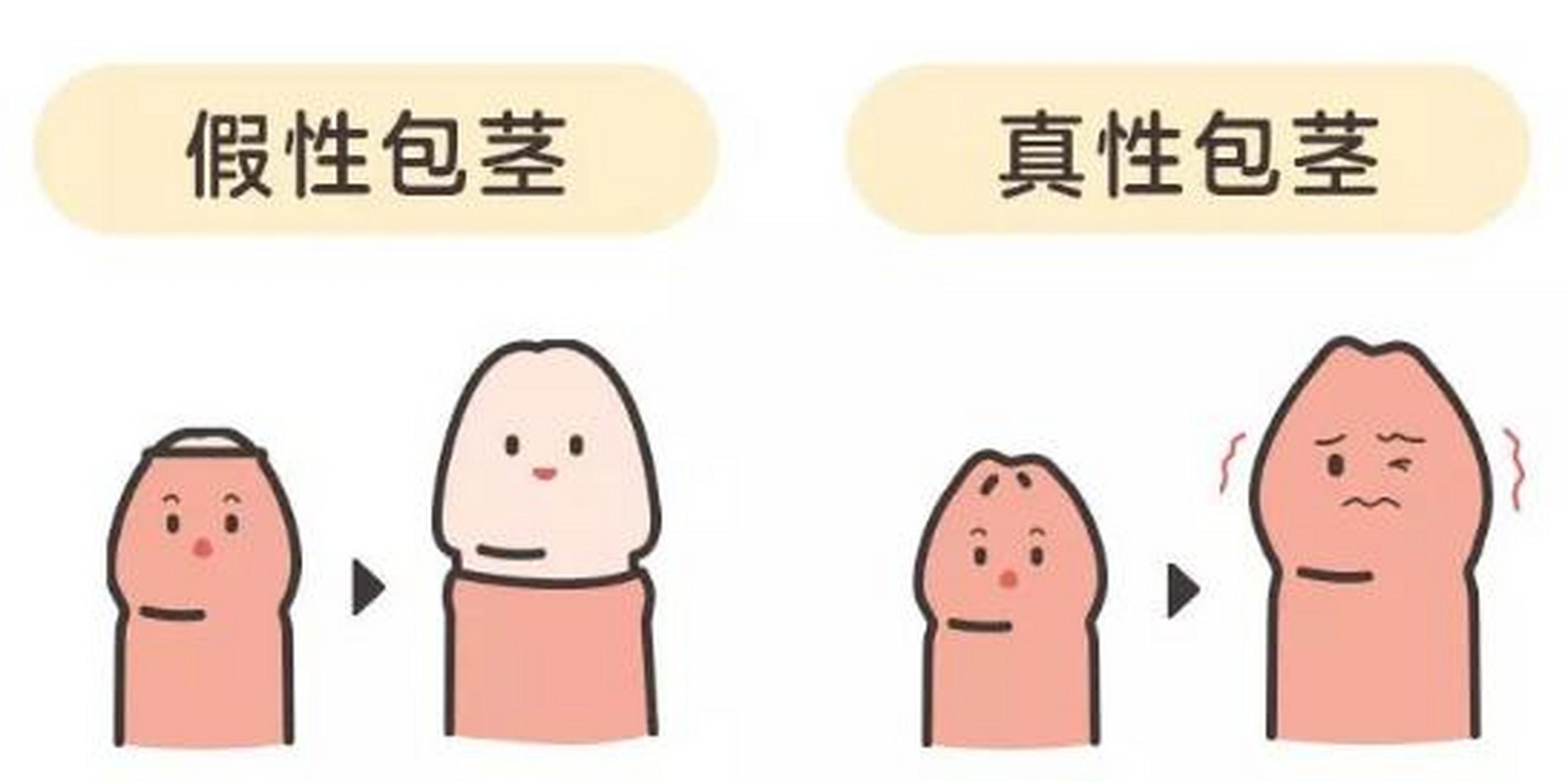病理性包茎是指小儿至3岁后包皮仍不能翻转至阴茎冠状沟.