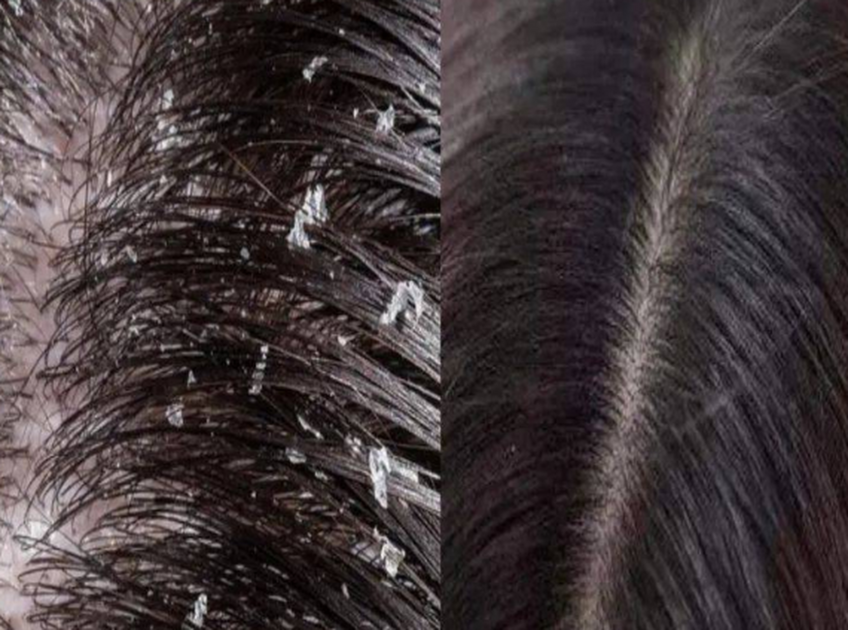 当我们发现头发上散布着这些小小的白色碎屑时,我们感到尴尬和不安.